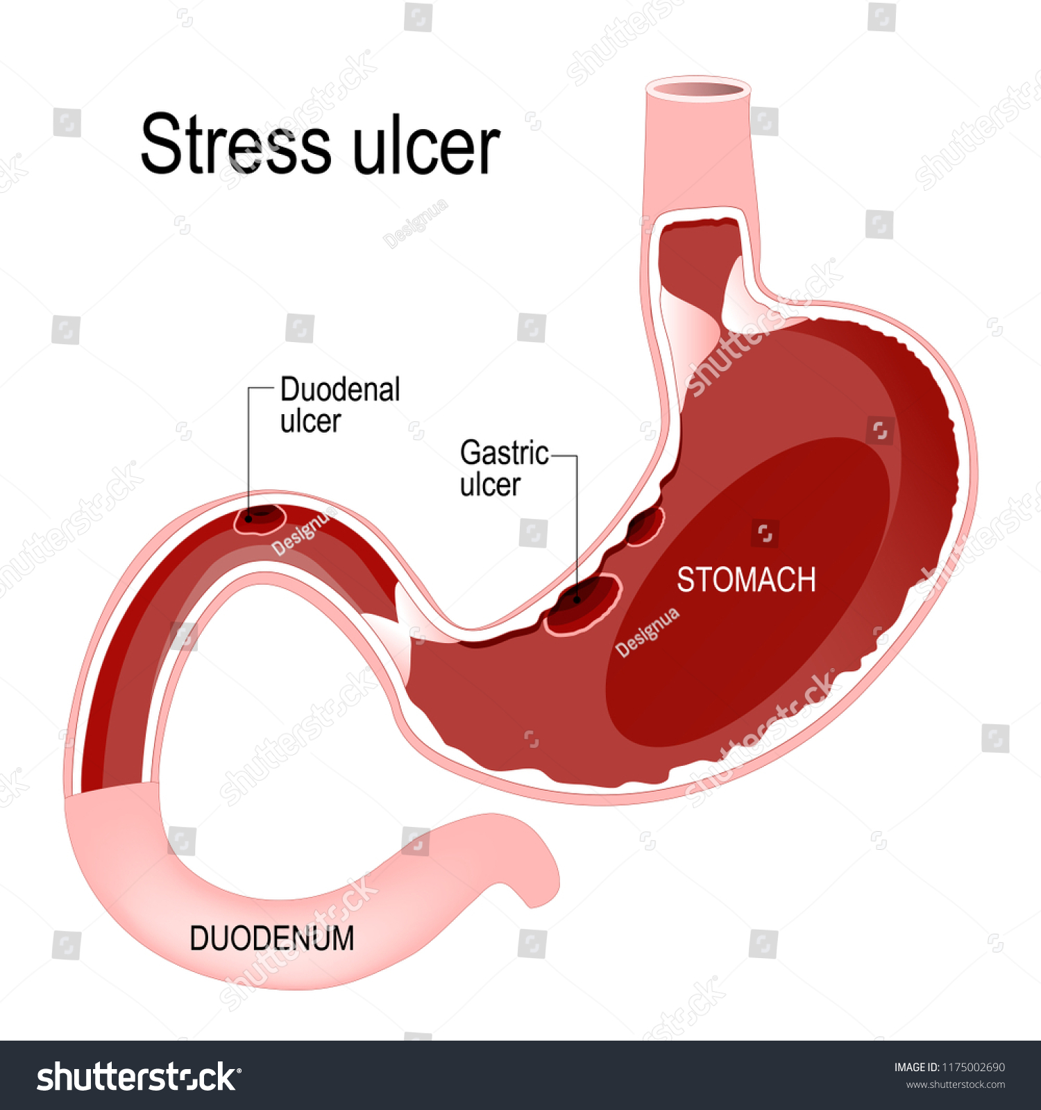 Peptic Ulcer Disease Gastric Duodenal Ulcer Stok İllüstrasyon 1175002690