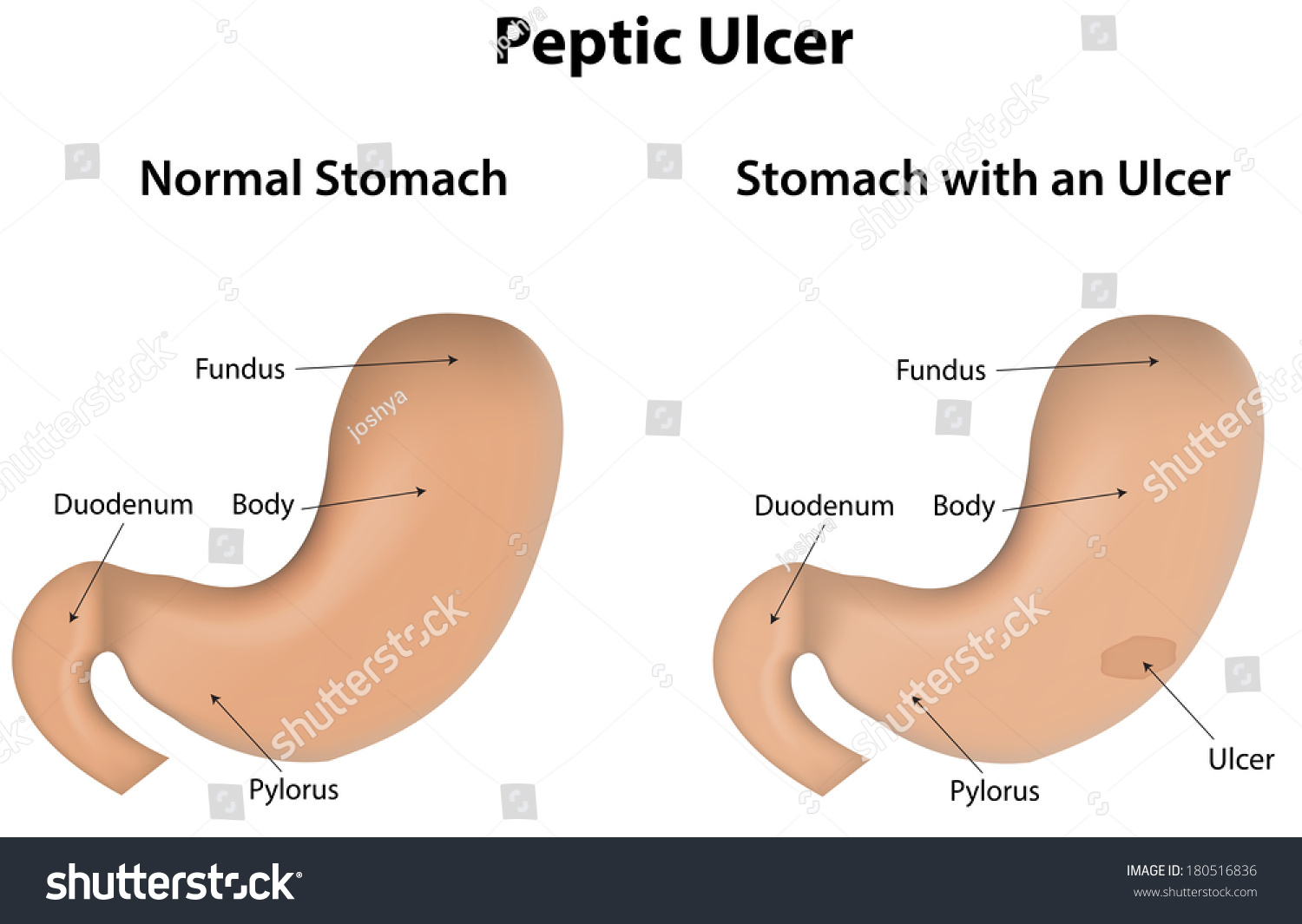 Peptic Ulcer Stomach Labeled Diagram Stock Illustration