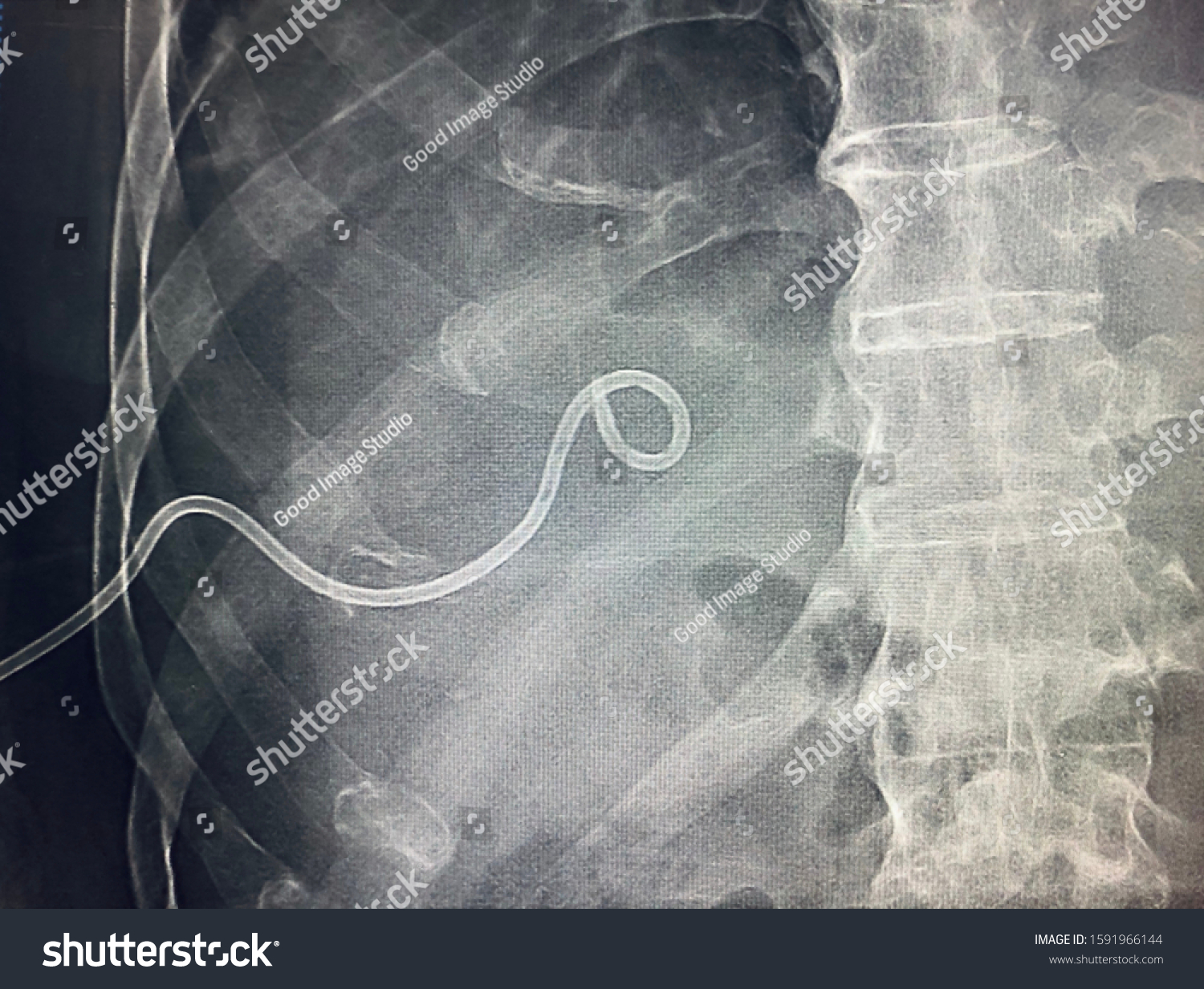 Percutaneous Transhepatic Biliary Drainage Ptbd Right Stock Photo Edit Now 1591966144