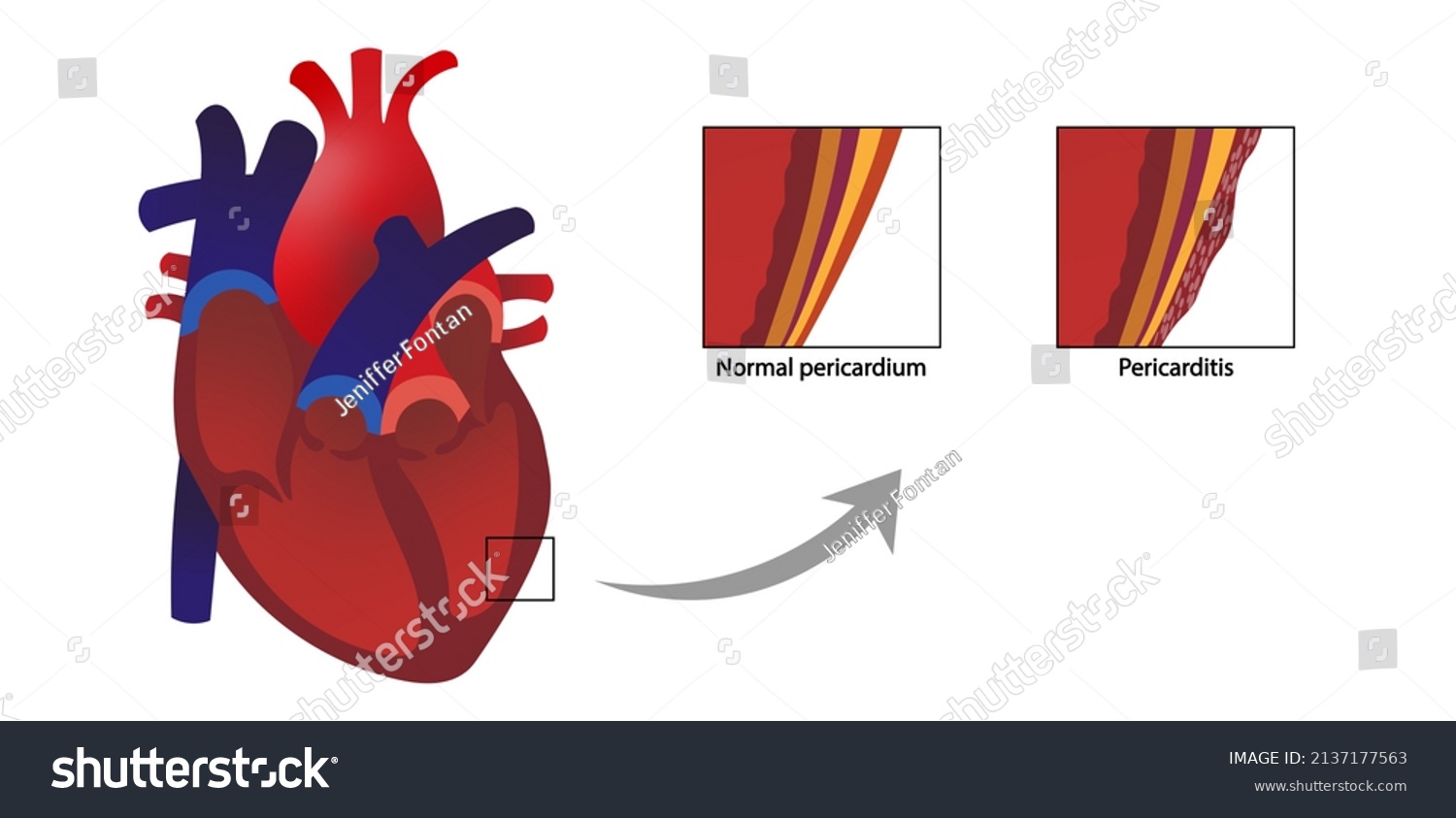 Pericarditis Normal Infected Pericardium Illustration Heart Stock 