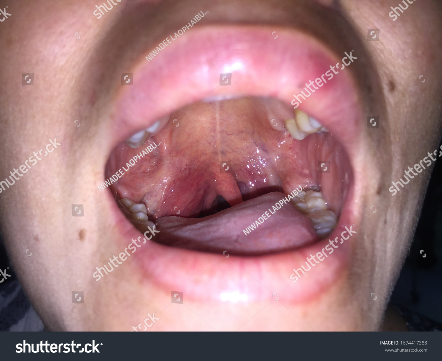 Absceso Peritonsillar Infección Dolor De Garganta Foto De Stock 1674417388 Shutterstock 
