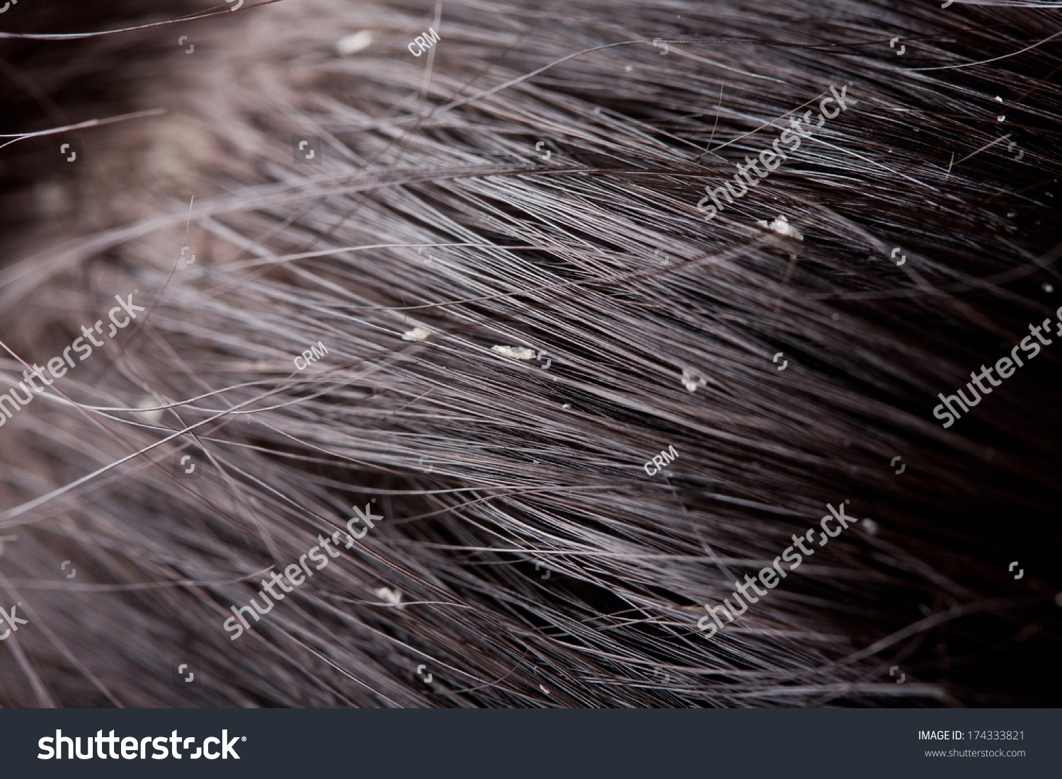 Persistent Dandruff Issue - Flaky Scalp Stock Photo 174333821 ...