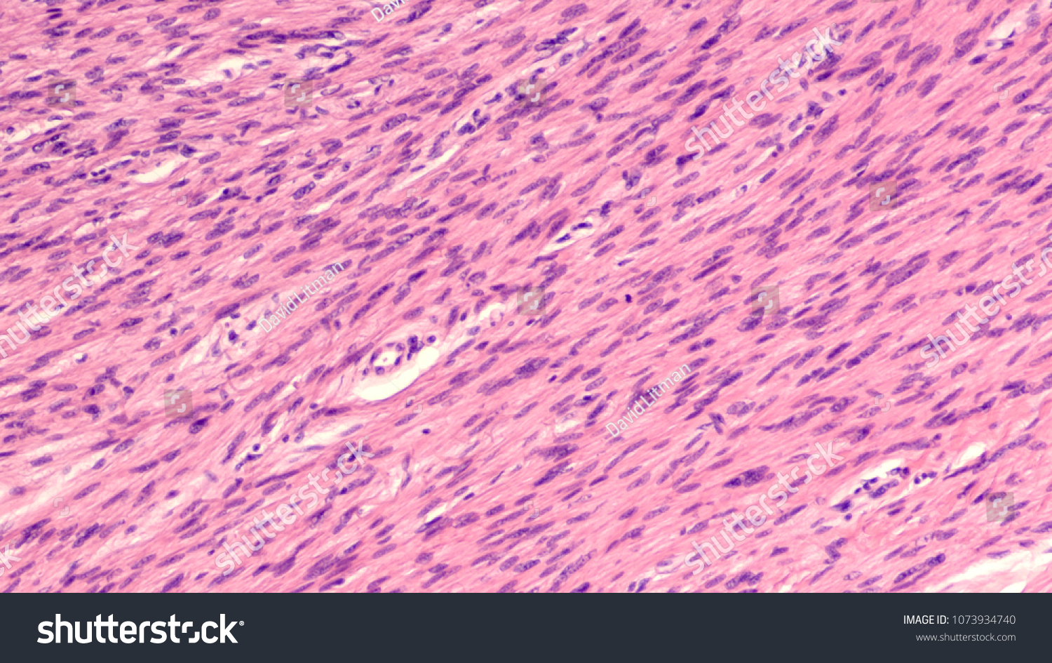 Soft tissue sarcoma Images, Stock Photos & Vectors | Shutterstock