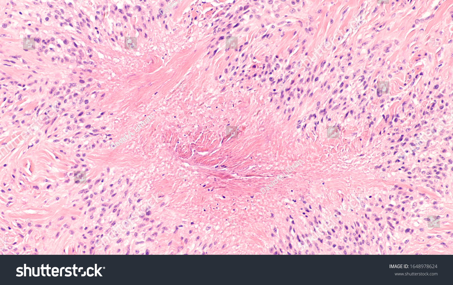 Photomicrograph Rheumatoid Nodule Firm Lump That Stock Photo 1648978624 ...