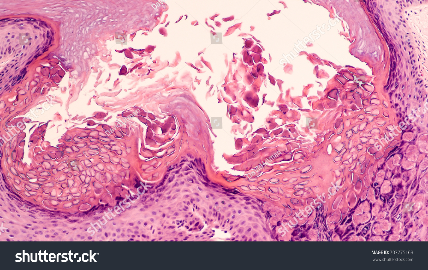 Photomicrograph Molluscum Contagiosum Viral Infection Skin Stock Photo