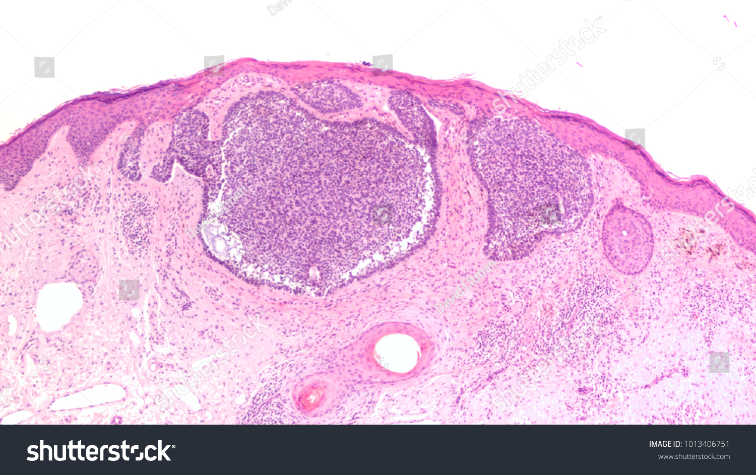 Photomicrograph Skin Biopsy Showing Basal Cell Stock Photo Edit Now