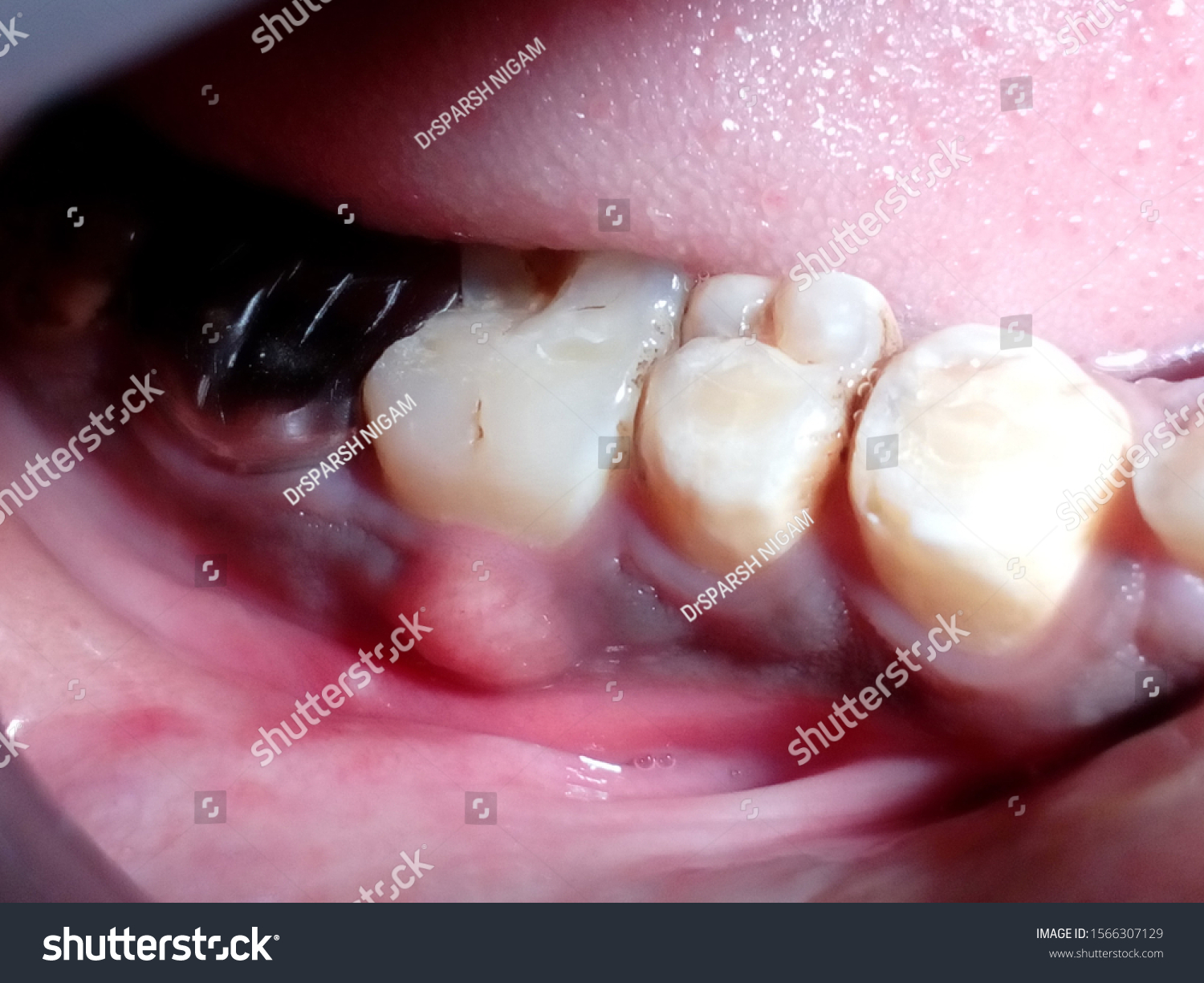 Photos Gum Swelling Due Dental Infection Stock Photo (Edit Now) 1566307129