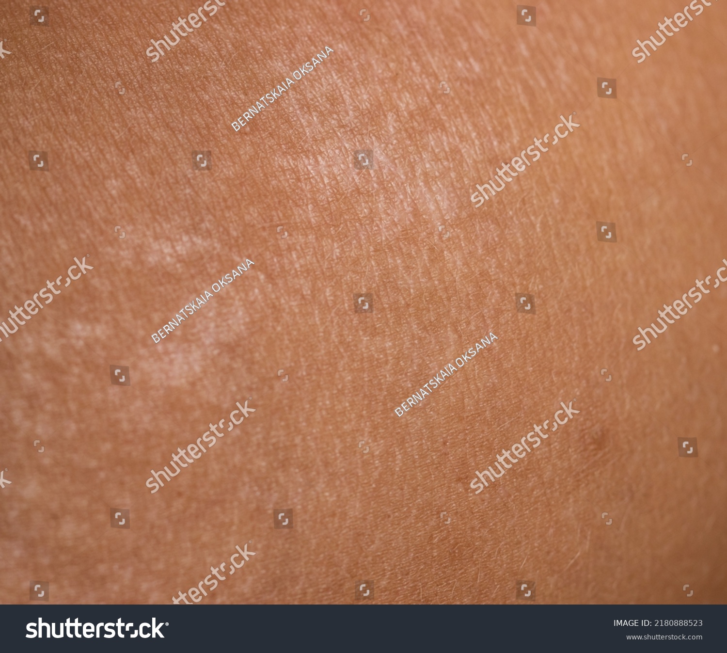 pigment-spots-on-skin-after-sunburn-stock-photo-2180888523-shutterstock