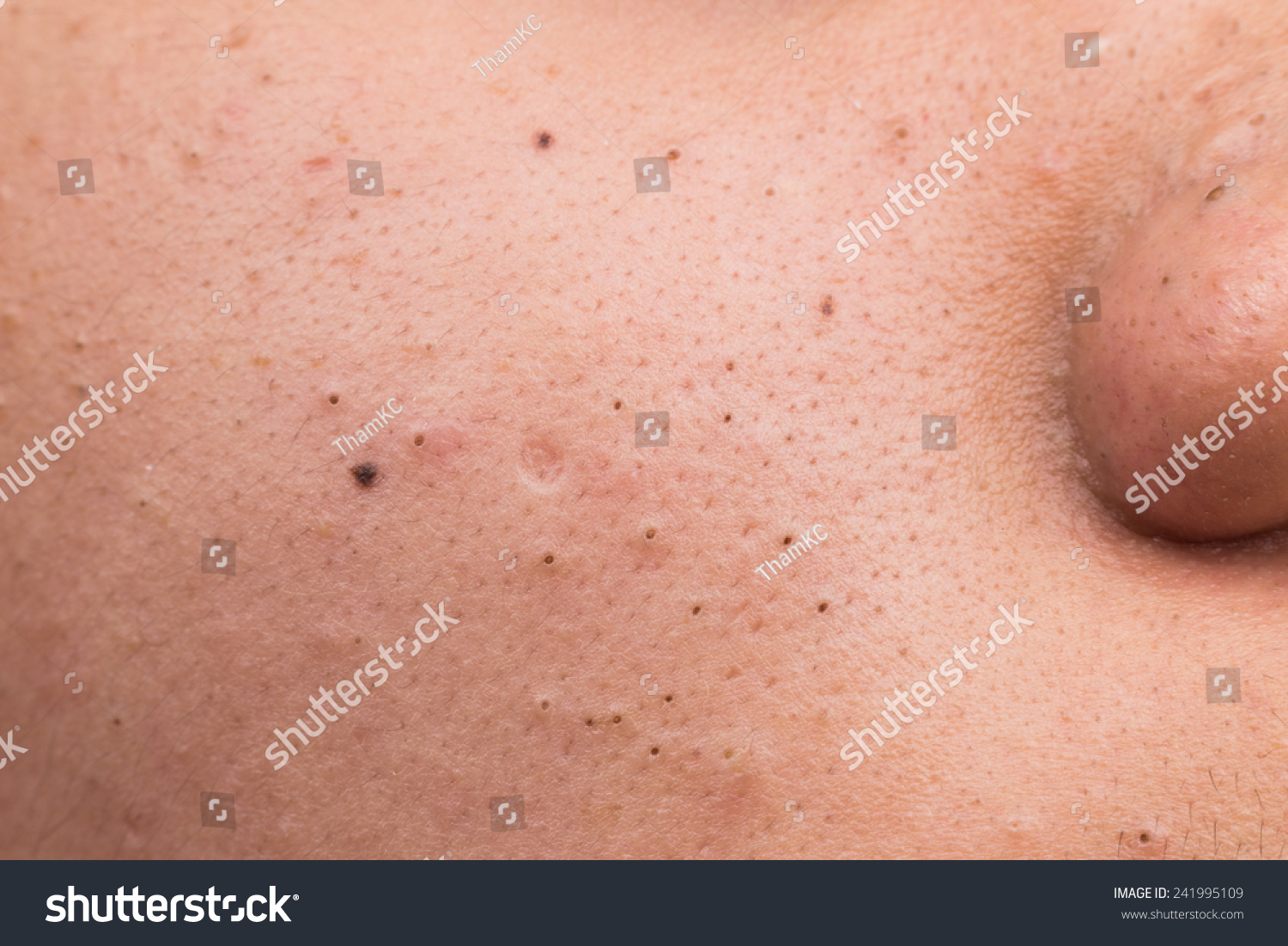 Pimple Blackheads On The Cheek Of An Asian Teenager Stock Photo ...