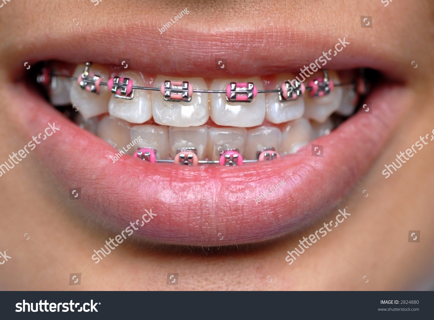 Pink Braces Stock Photo (Edit Now) 2824880