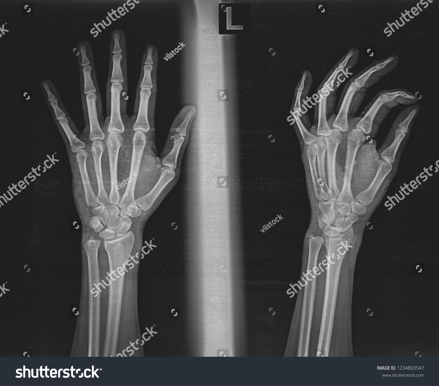 Plain Film Xray Left Hand Stock Photo (Edit Now) 1234803547