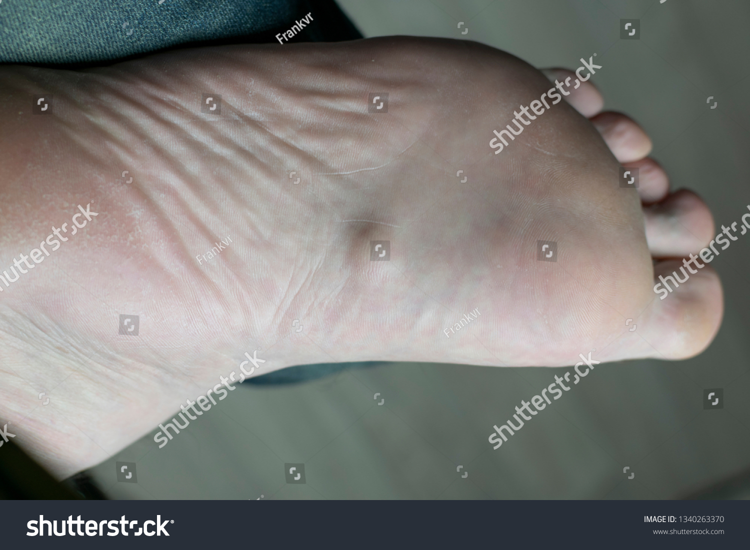 11-plantar-fibroma-images-stock-photos-vectors-shutterstock