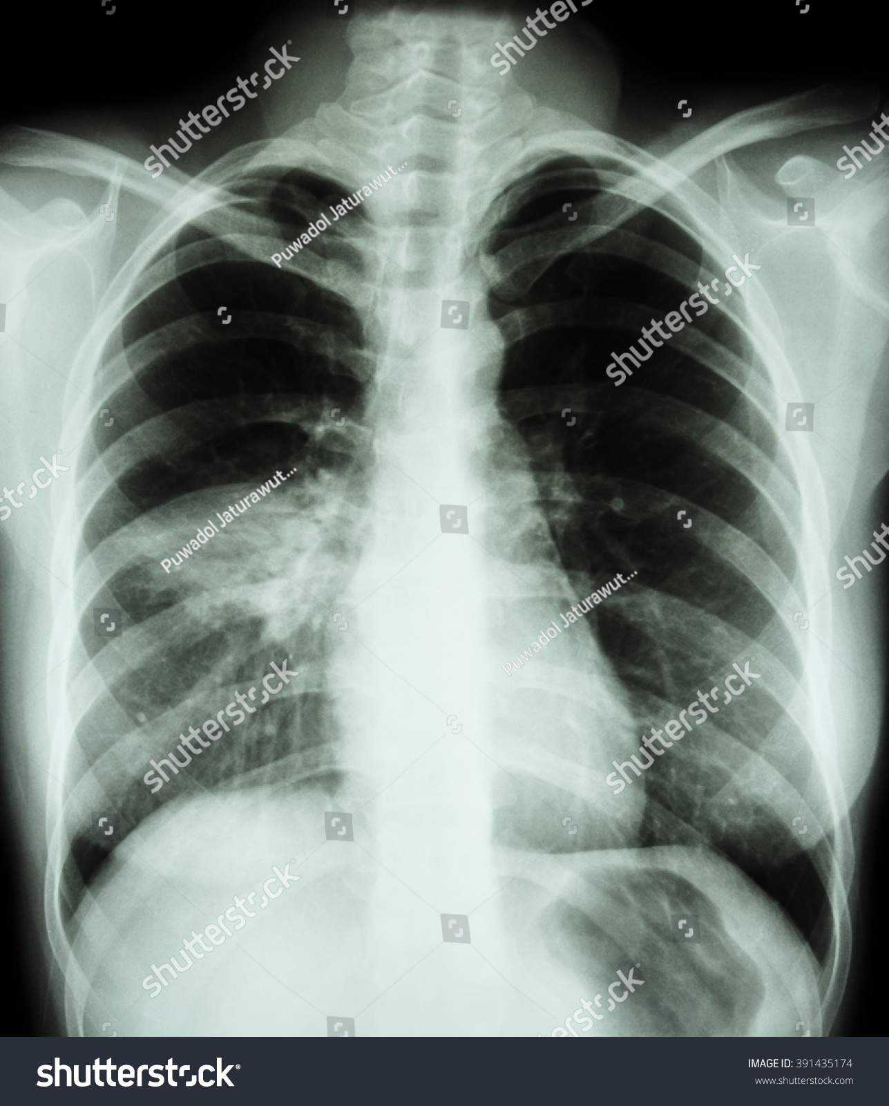 Pneumonia X Film Chest X Ray Show Alveolar Infiltrate At Right My Xxx