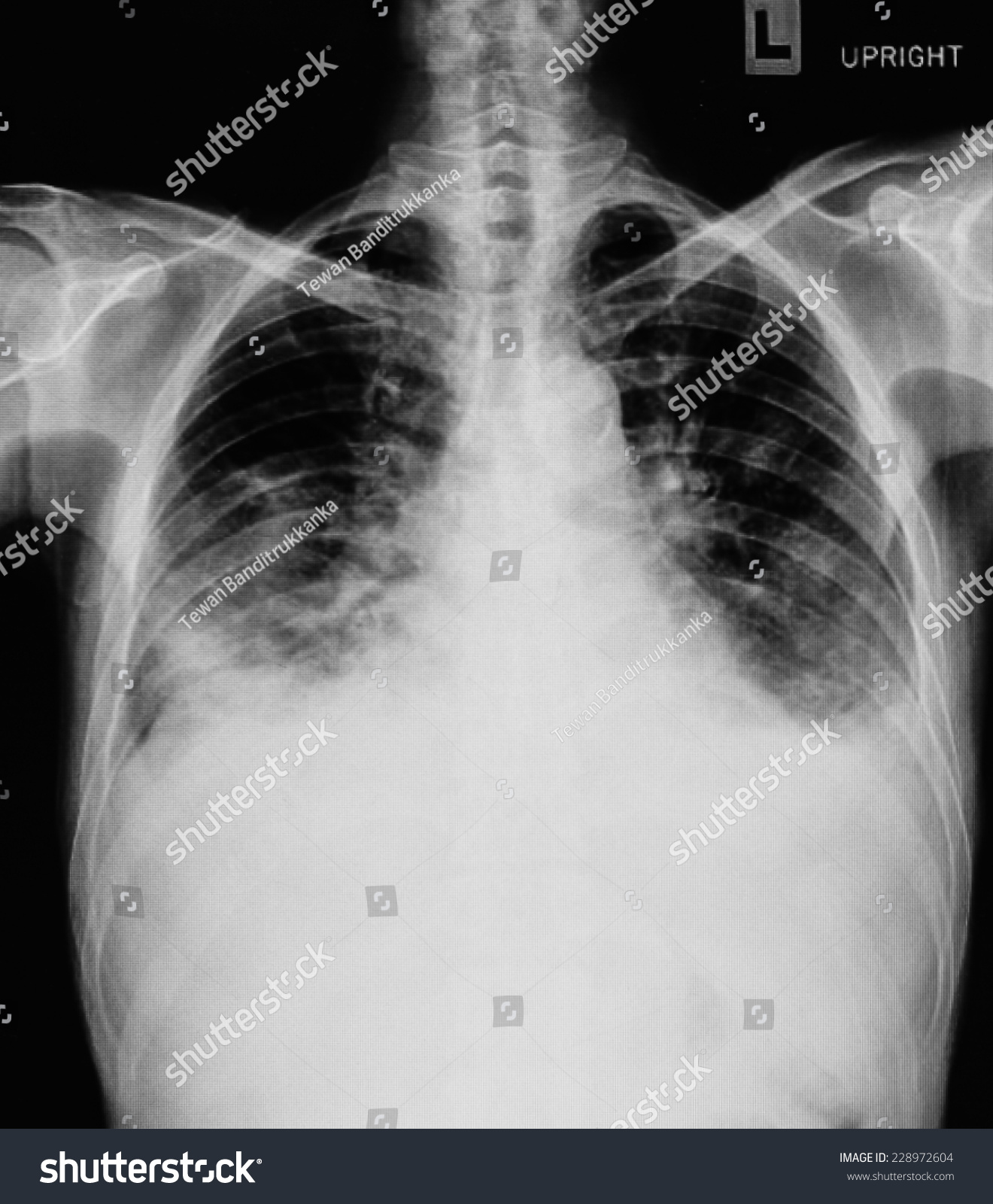 Pneumonia Test Scanning Modern Xrays Radiography Stock Photo 228972604 ...