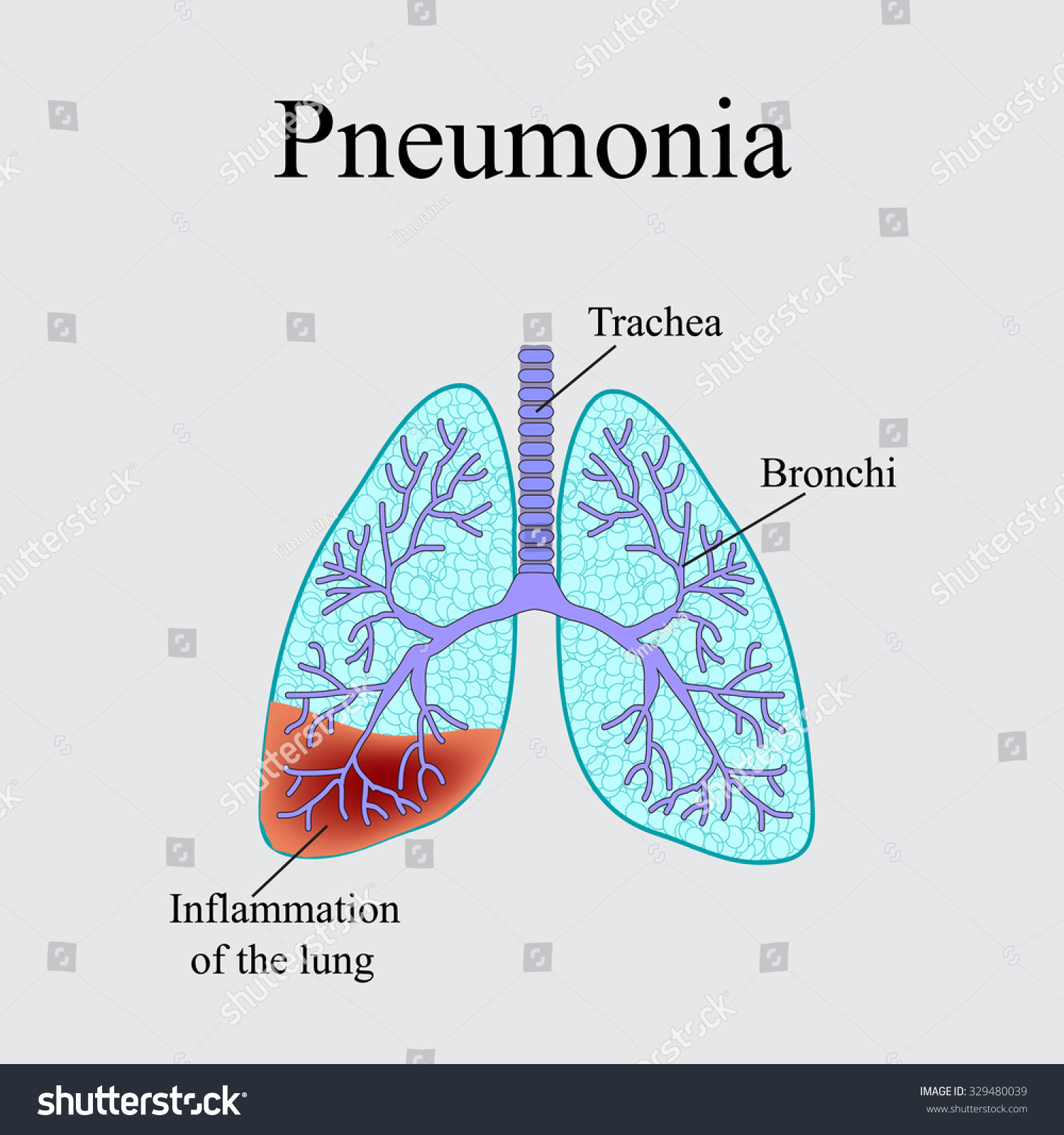 Pneumonia Anatomical Structure Human Lung Illustration Hình Minh Họa