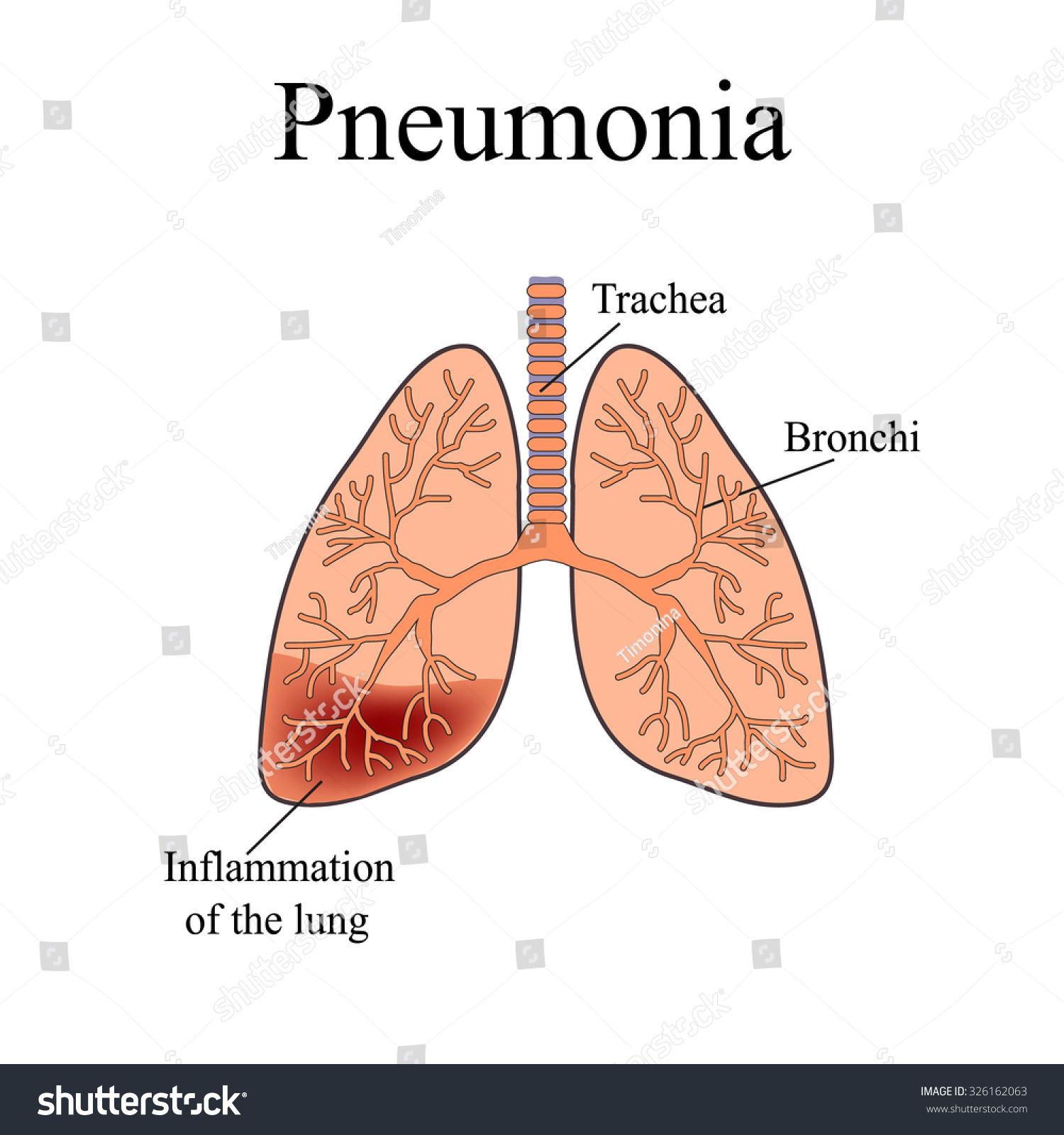 Pneumonia Anatomical Structure Human Lung Illustration Stock ...