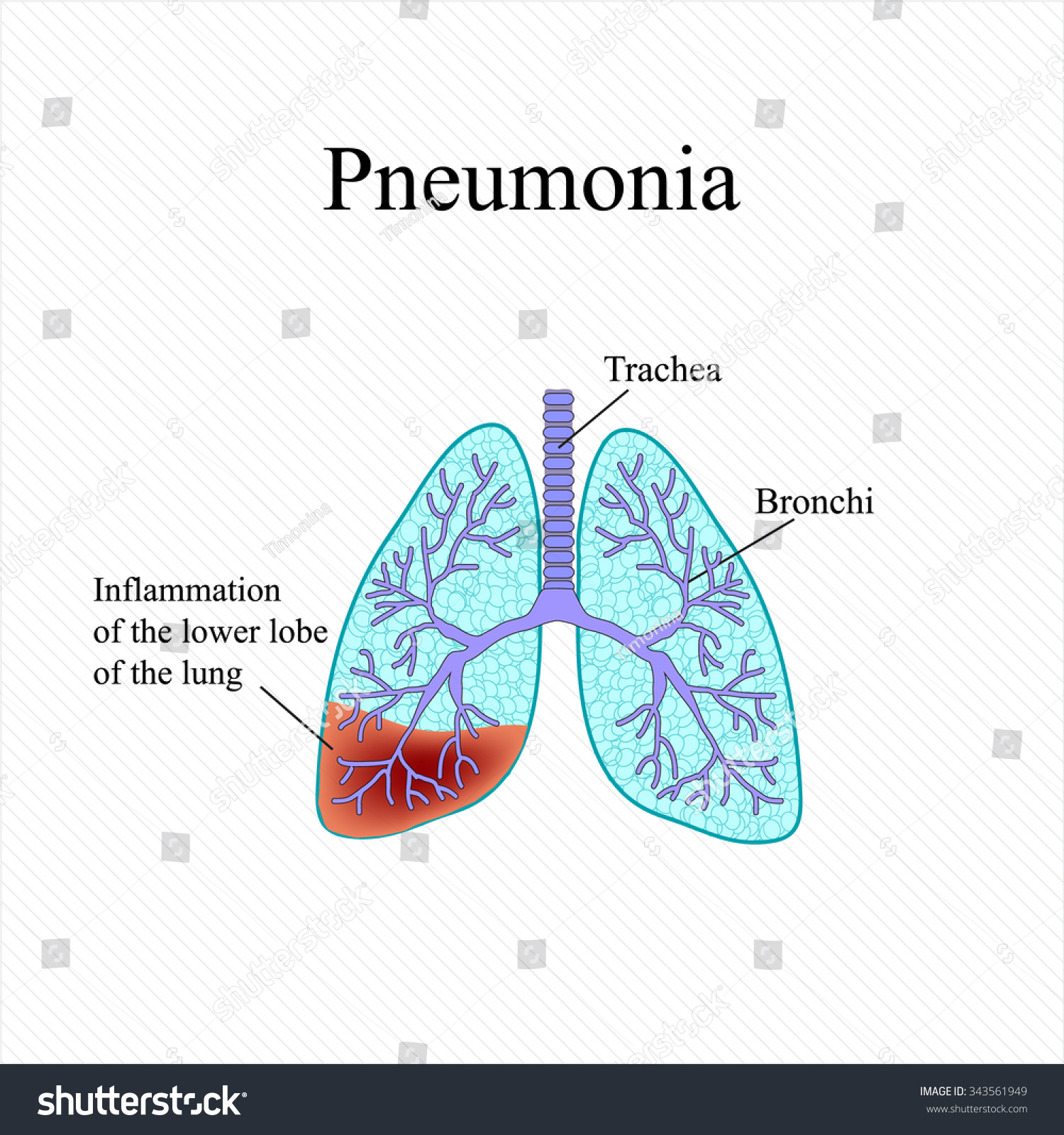 Pneumonia Anatomical Structure Human Lung Inflammation 스톡 일러스트 343561949