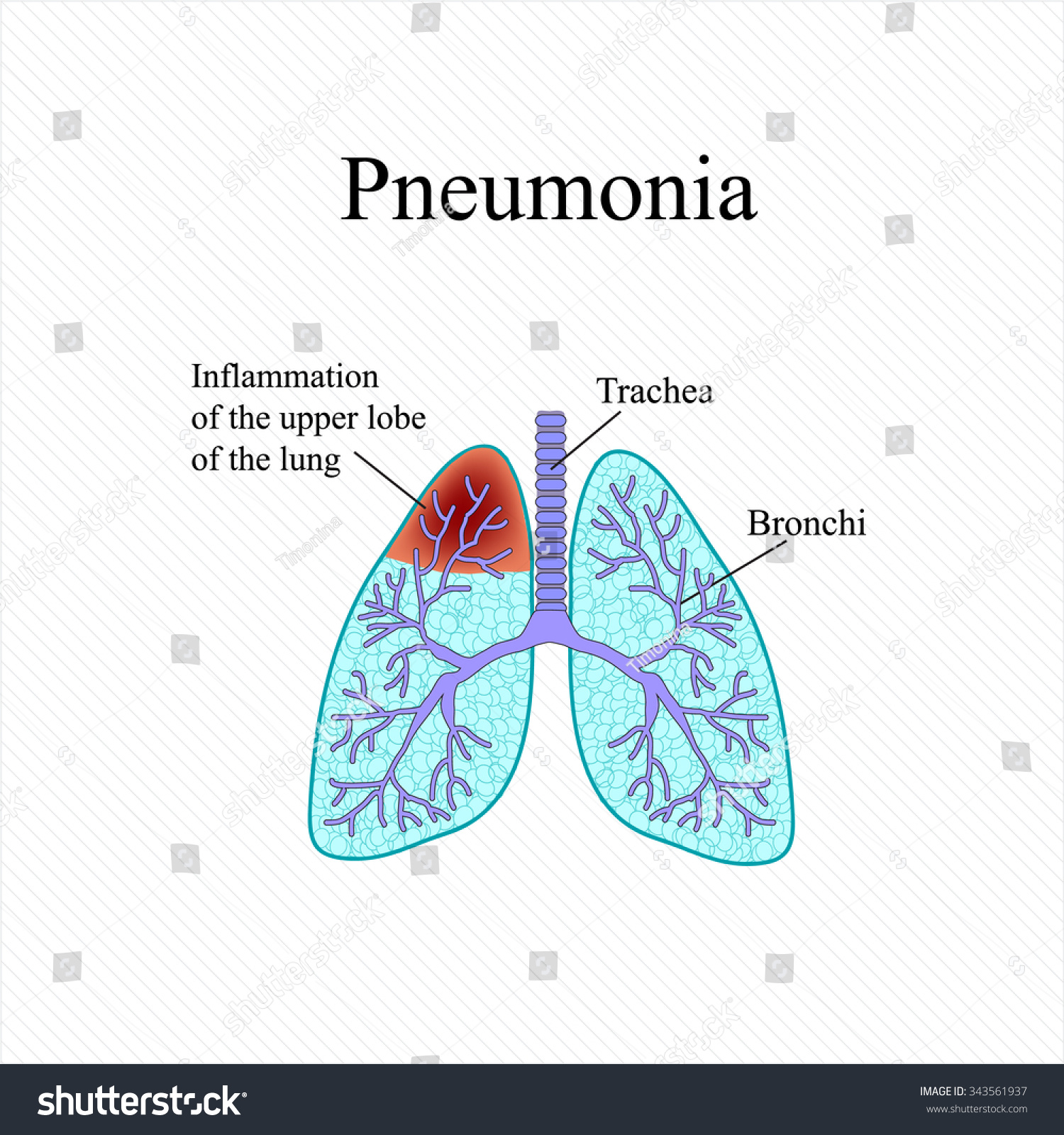 Pneumonia Anatomical Structure Human Lung Inflammation 스톡 일러스트 343561937