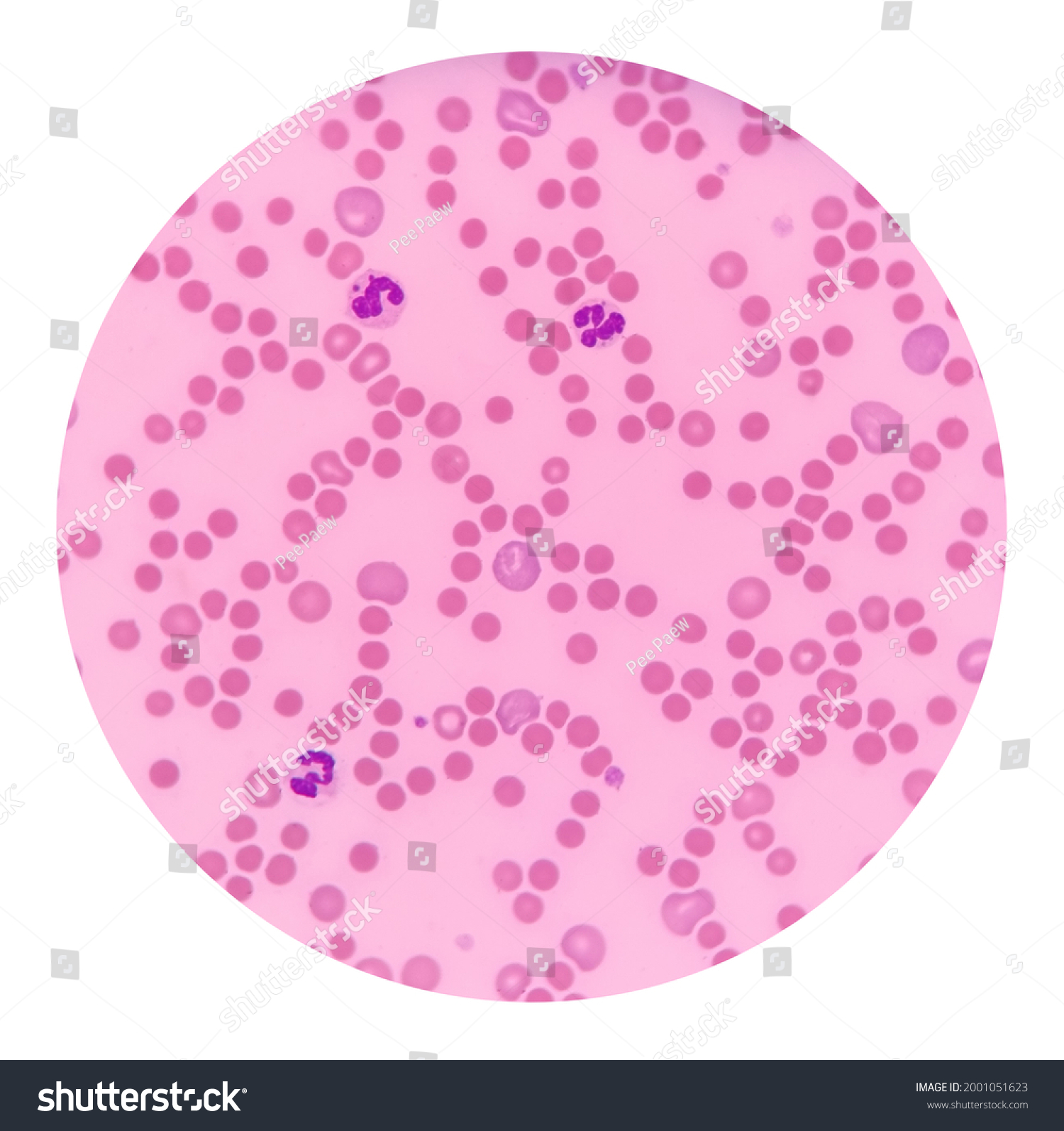 Hereditary Spherocytosis Blood Smear