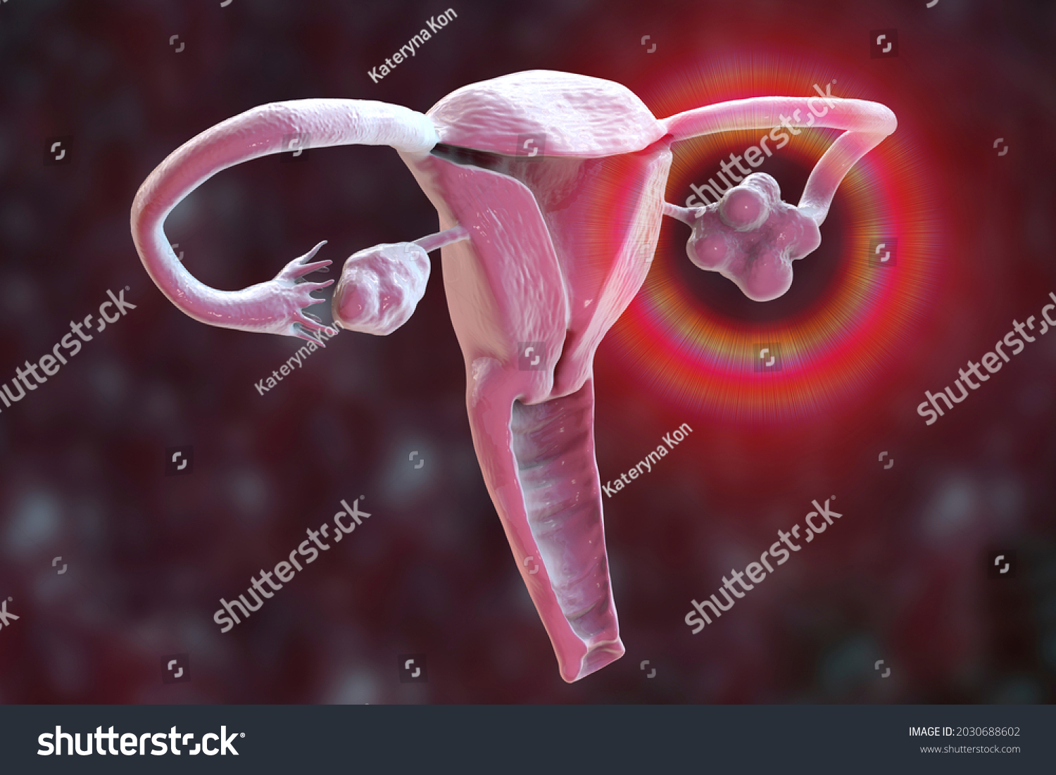 Polycystic Ovary Syndrome 3d Illustration Showing Stock Illustration ...