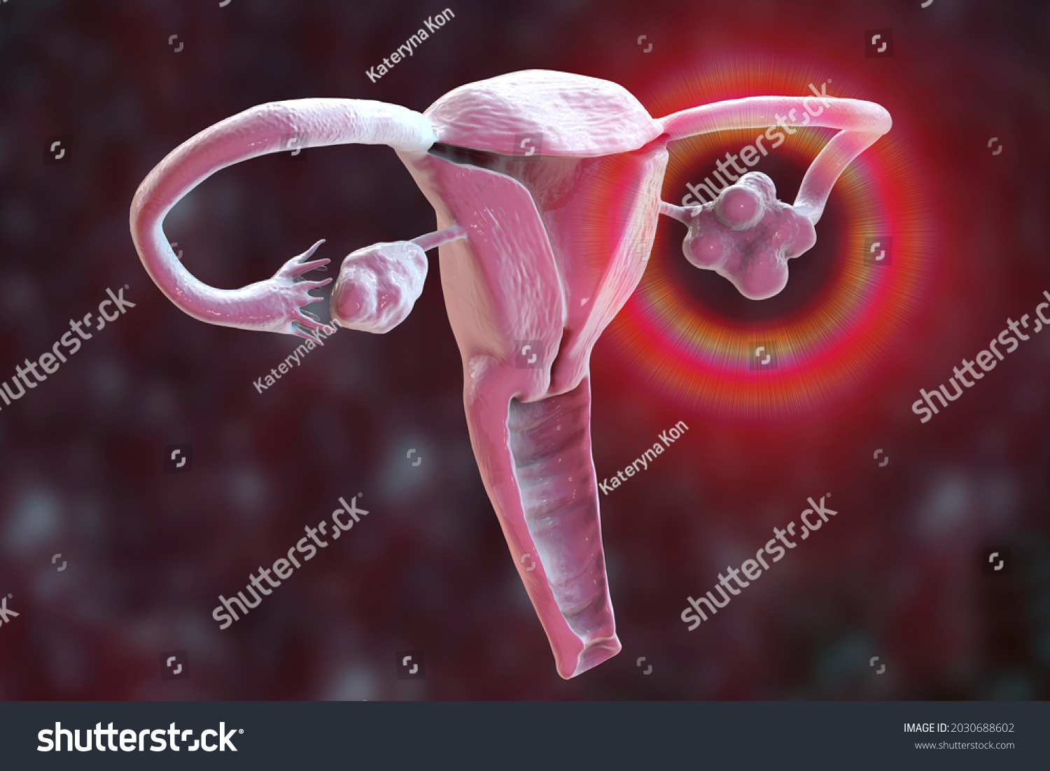 Polycystic Ovary Syndrome 3d Illustration Showing Stock Illustration