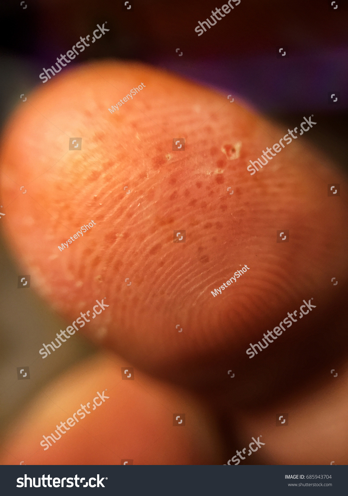 Photo De Stock Pompholyx Eczema Dyshidrosis Small Blisters Under