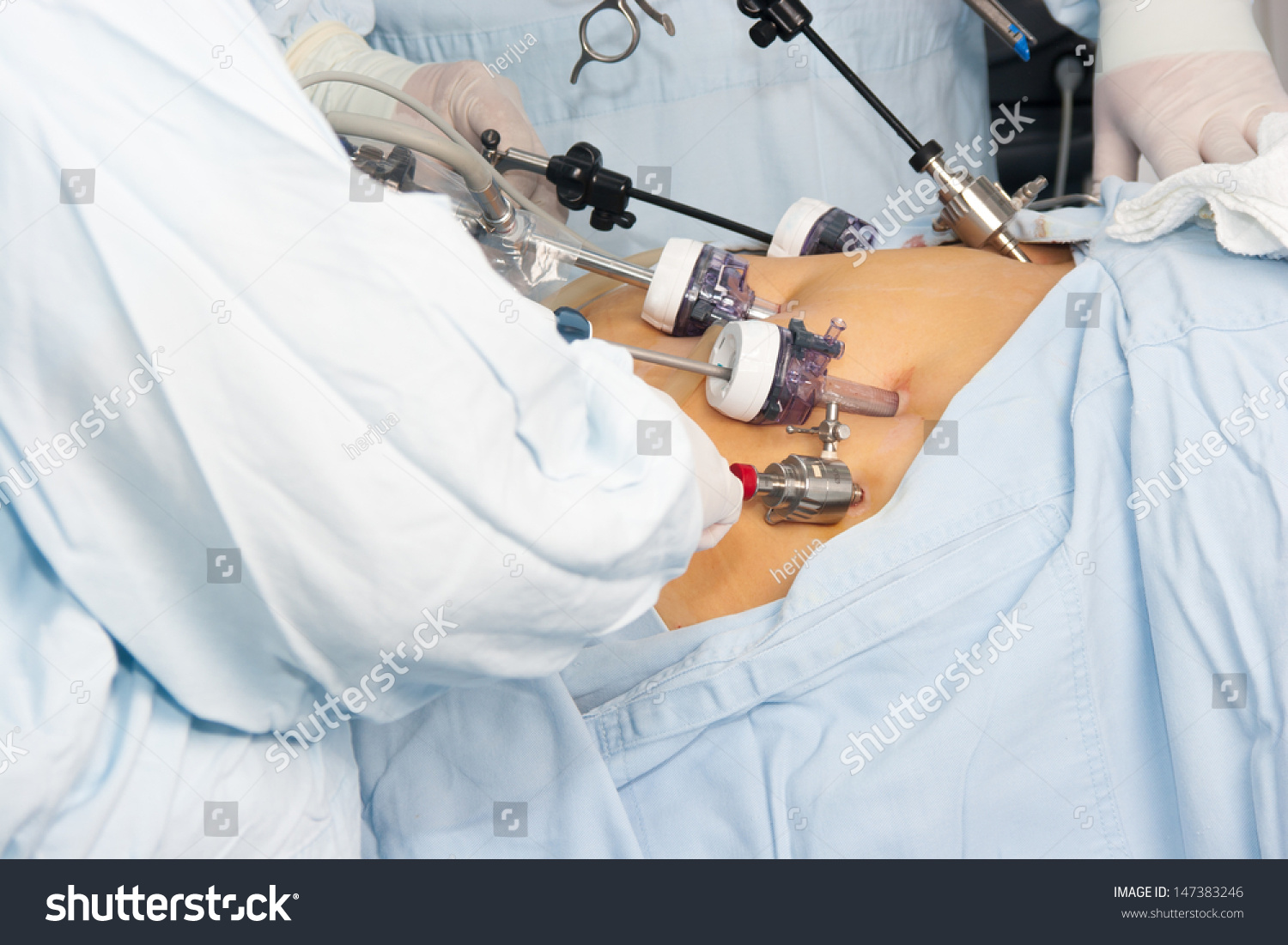 Portrait Gastric Bypass Surgery Hospital Stock Photo 147383246 ...