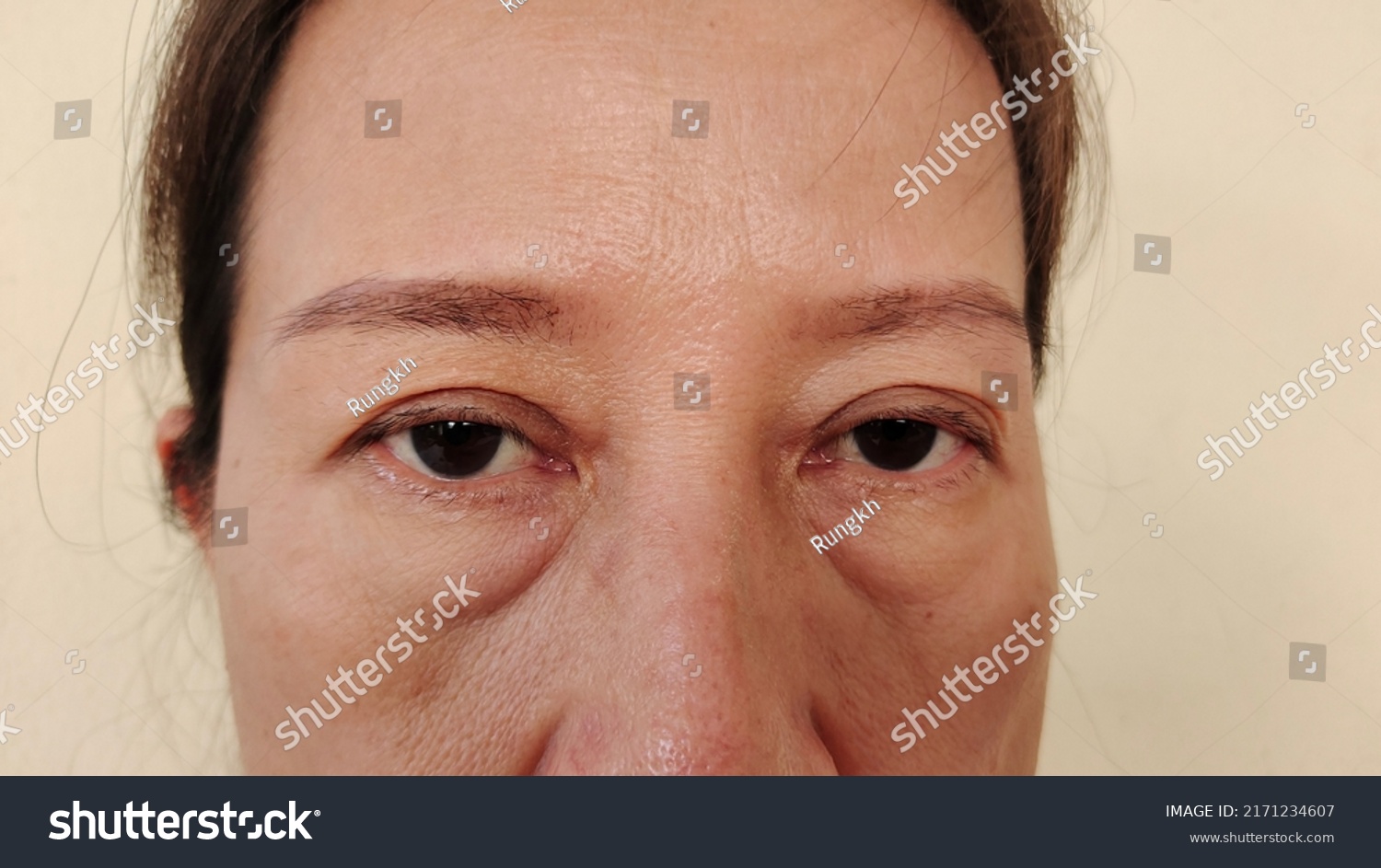 Portrait Showing Wrinkles Around Eyes Problem Stock Photo 2171234607 ...