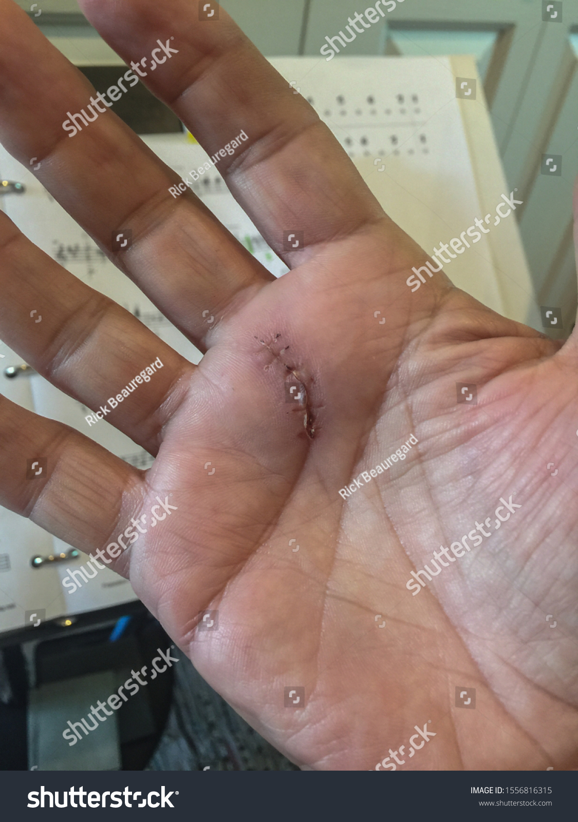 Post Operative View Incision Below Middle Stock Photo Edit Now 1556816315