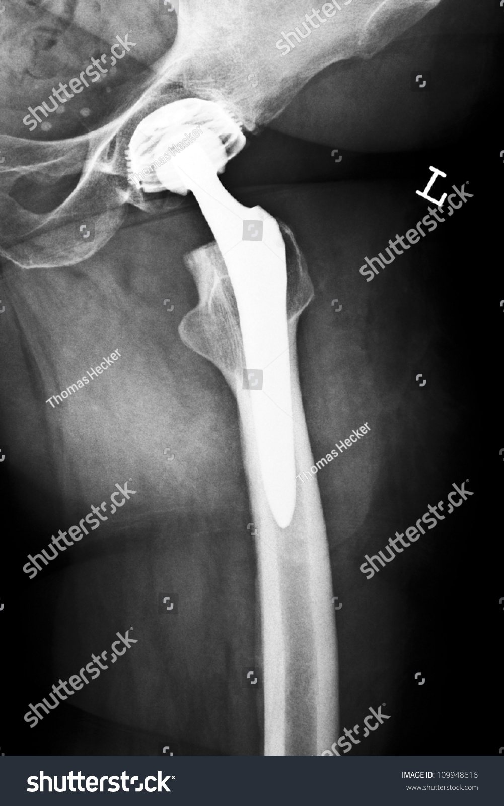 Postsurgical Xray Image Shows Artificial Hip Stock Photo 109948616 ...