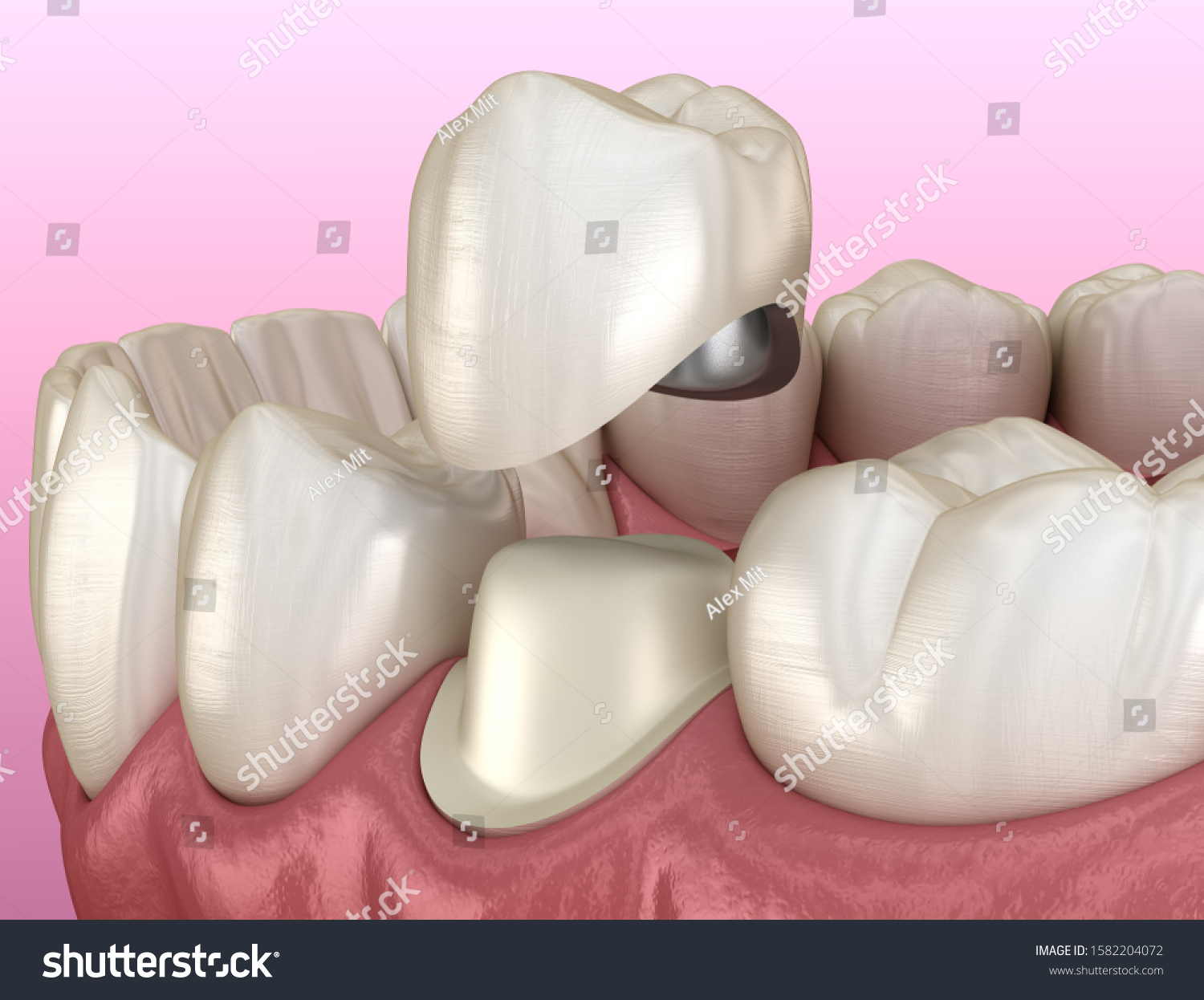 Preparated Premolar Tooth Dental Metalceramic Crown Stock Illustration ...