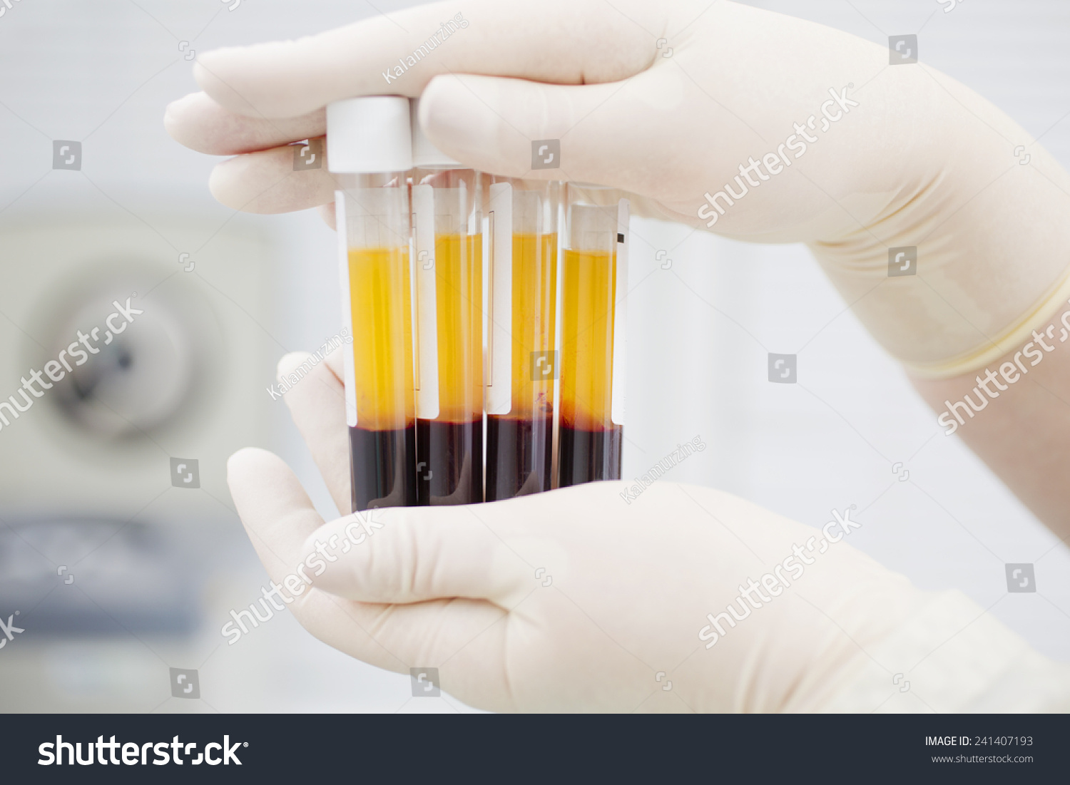 Preparing Plasmolifting Blood Tubes Two Layers Stock Image