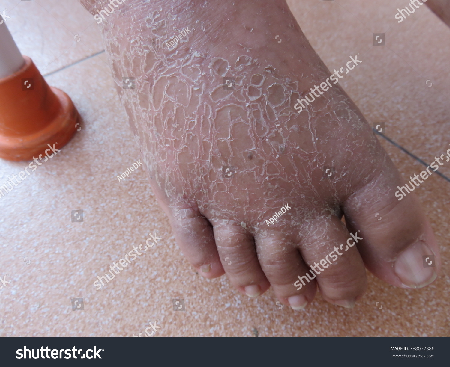dry skin peeling on feet
