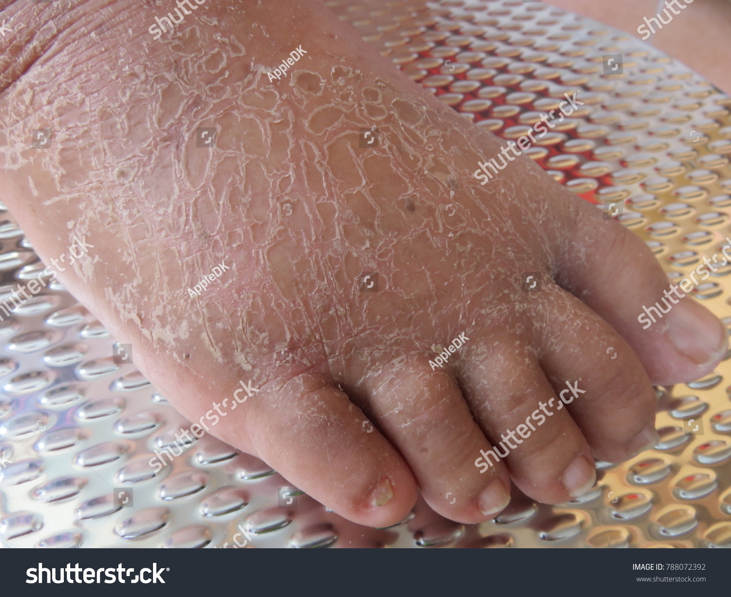 dry peeling feet
