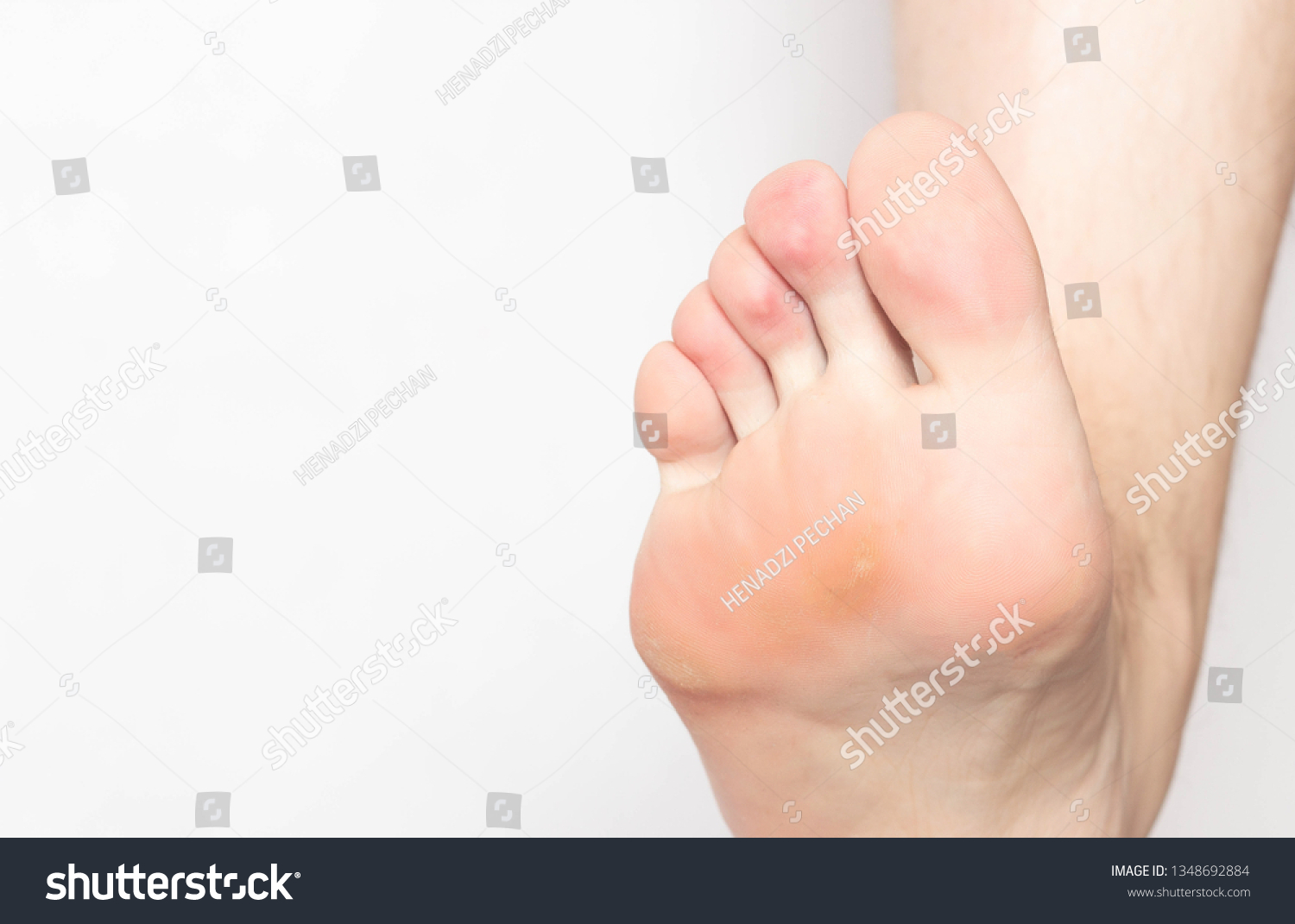 Problem Skin Calluses Corns On Sole Stock Photo (Edit Now) 1348692884