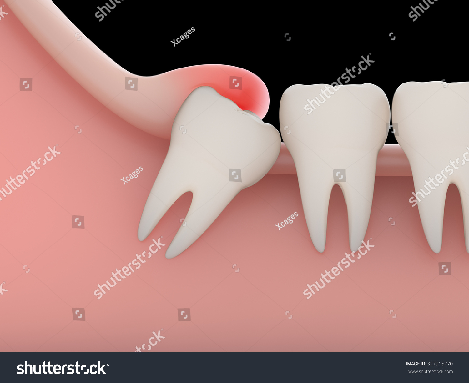 Problems Caused By Impacted Wisdom Teeth Include.Infection(Rendering ...