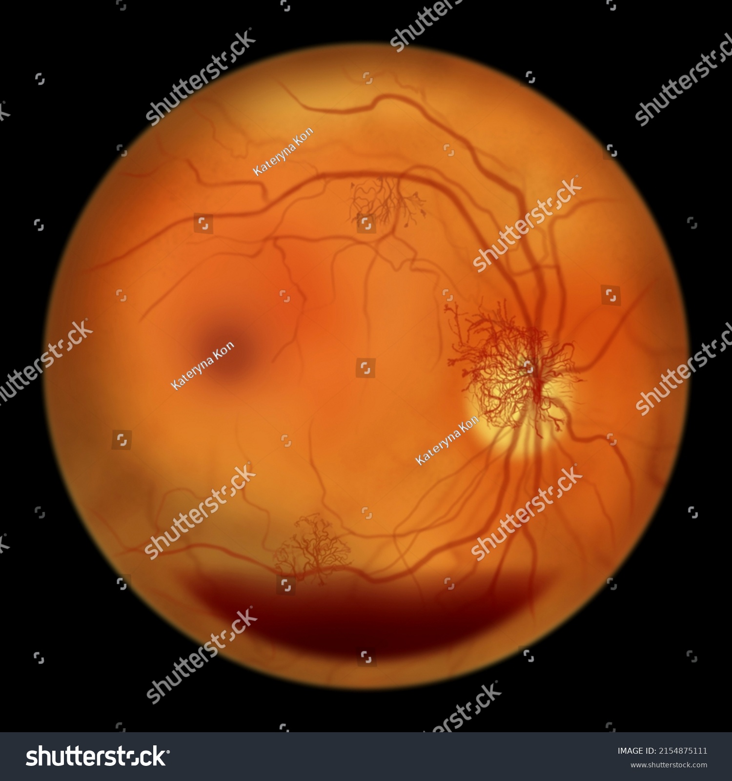 Proliferative Diabetic Retinopathy Illustration Showing Preretinal ...