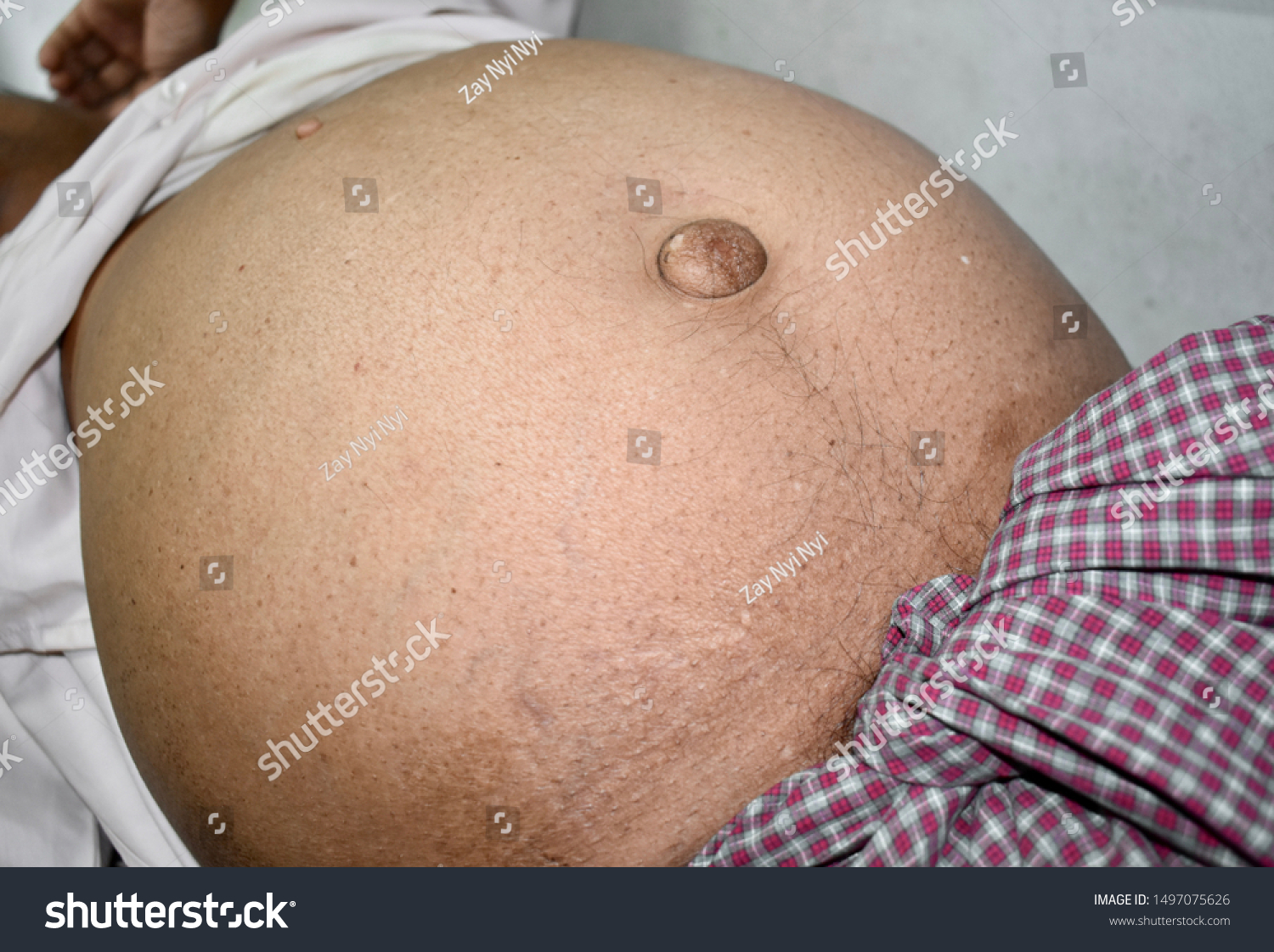 1497075626-prominent-abdominal-distension