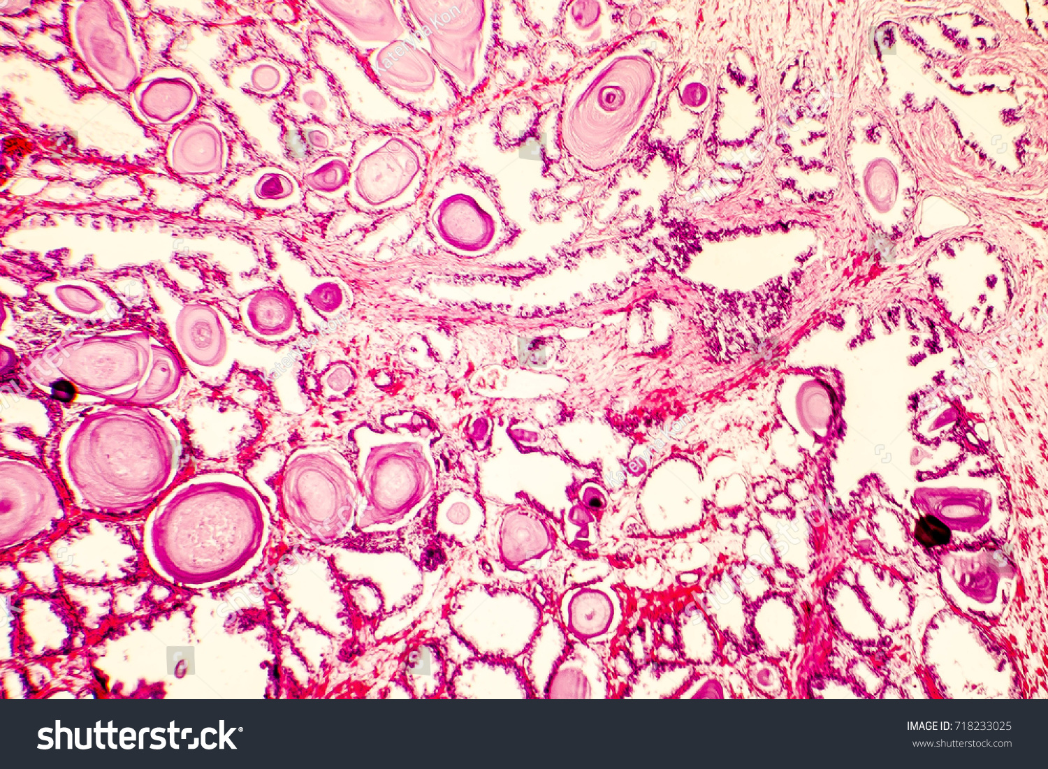 Prostate Hyperplasia Photomicrograph Showing Dilated Glands Stock Photo ...