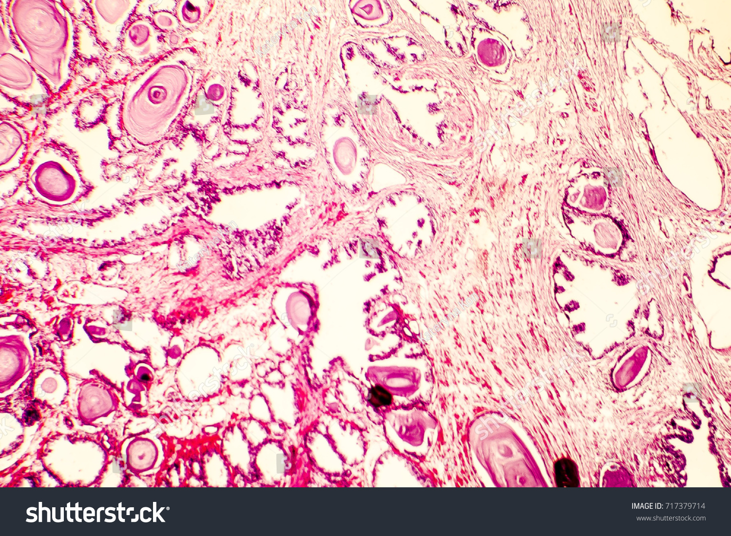 Prostate Hyperplasia Photomicrograph Showing Dilated Glands Stock Photo ...