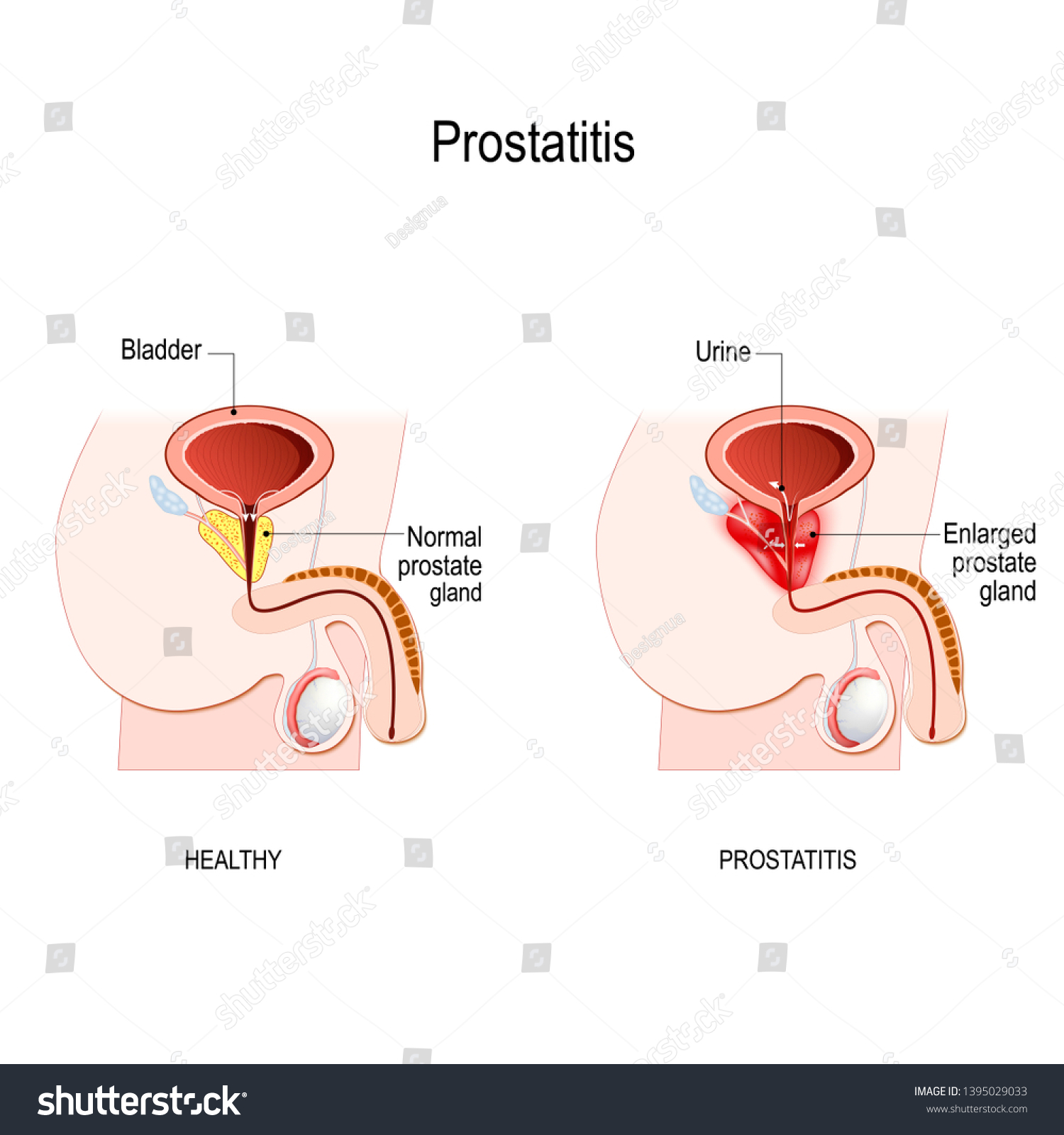 Prostatitis Swelling Inflammation Prostate Gland That Stock Illustration 1395029033