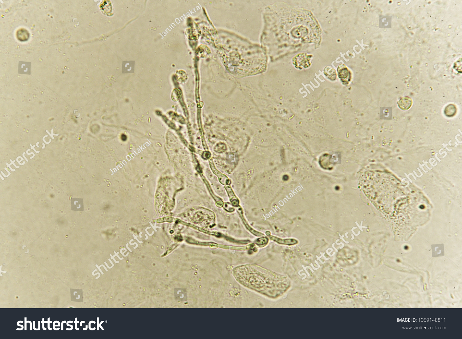 Pseudohyphae Budding Yeast Cells Patient Urine Stock Photo (Edit Now ...