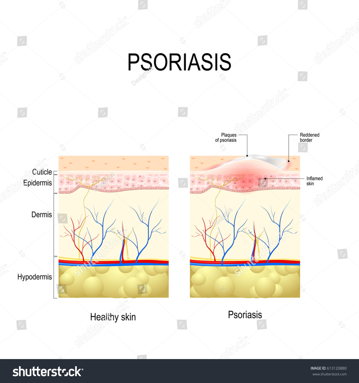 Psoriasis Human Skin Layer Close Healthy Stock Illustration 613120880 ...