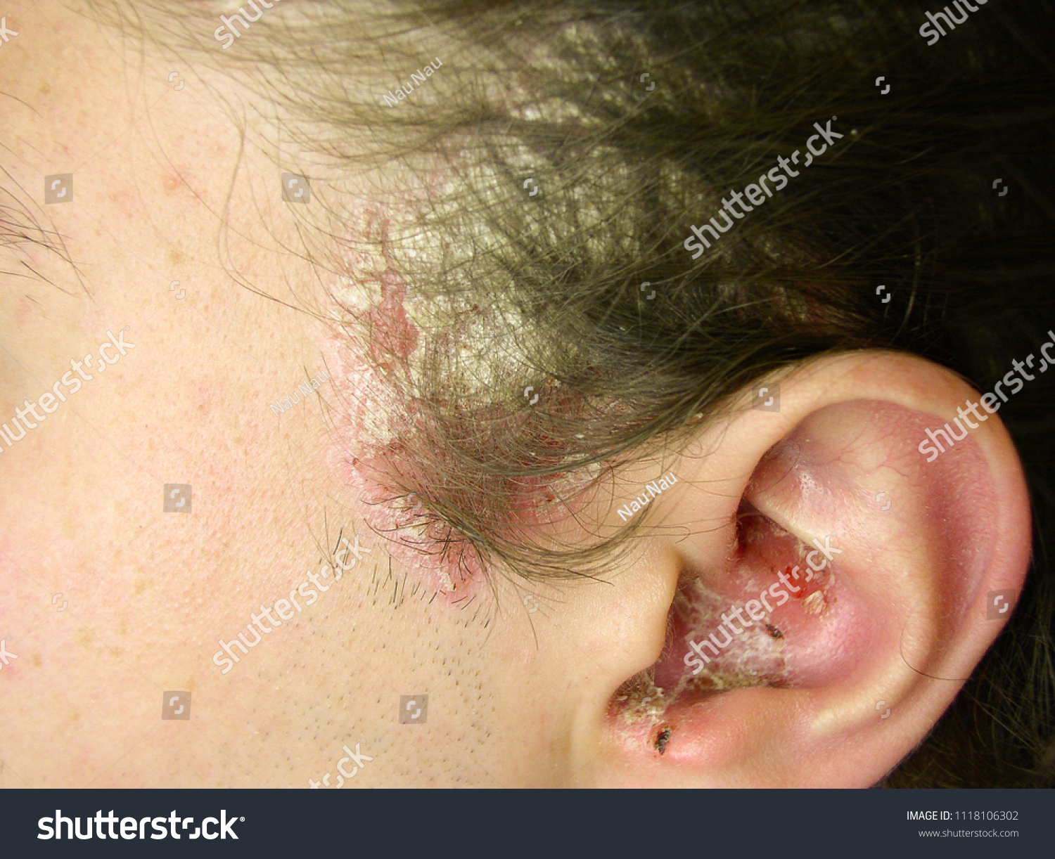 頭皮乾癬 側頭部の皮膚に乾癬性赤色化 皮剥き 耳痛 の写真素材 今すぐ編集