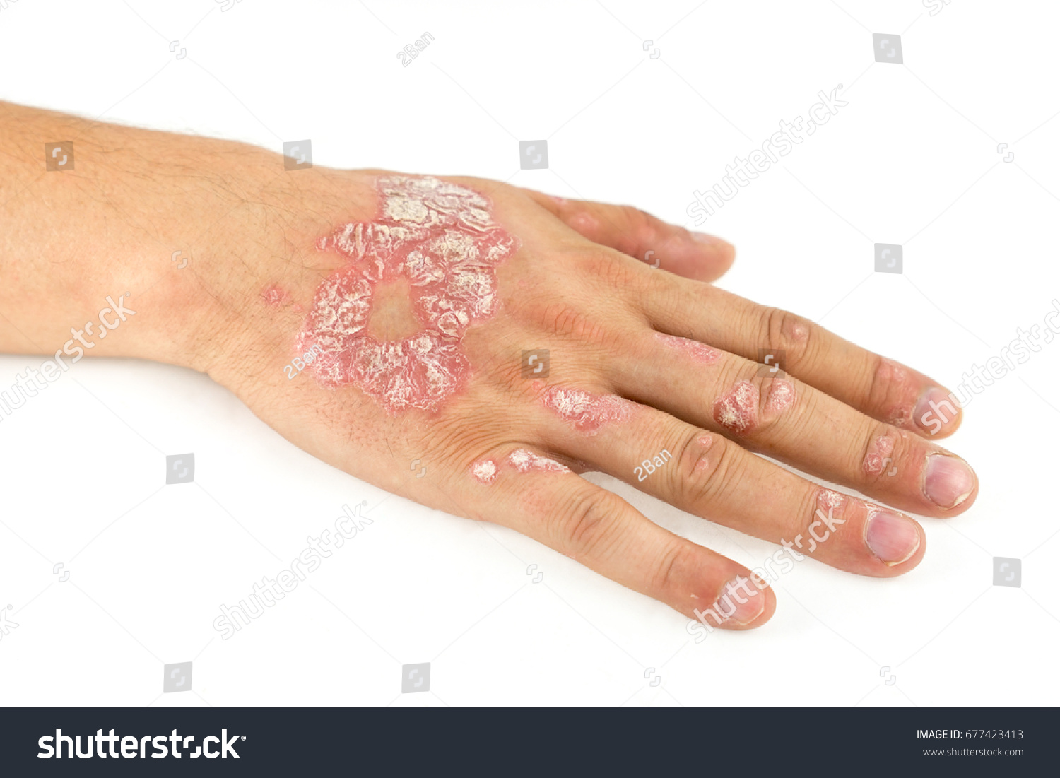 Psoriasis Vulgaris On Male Hand Finger Stock Photo 677423413 - Shutterstock