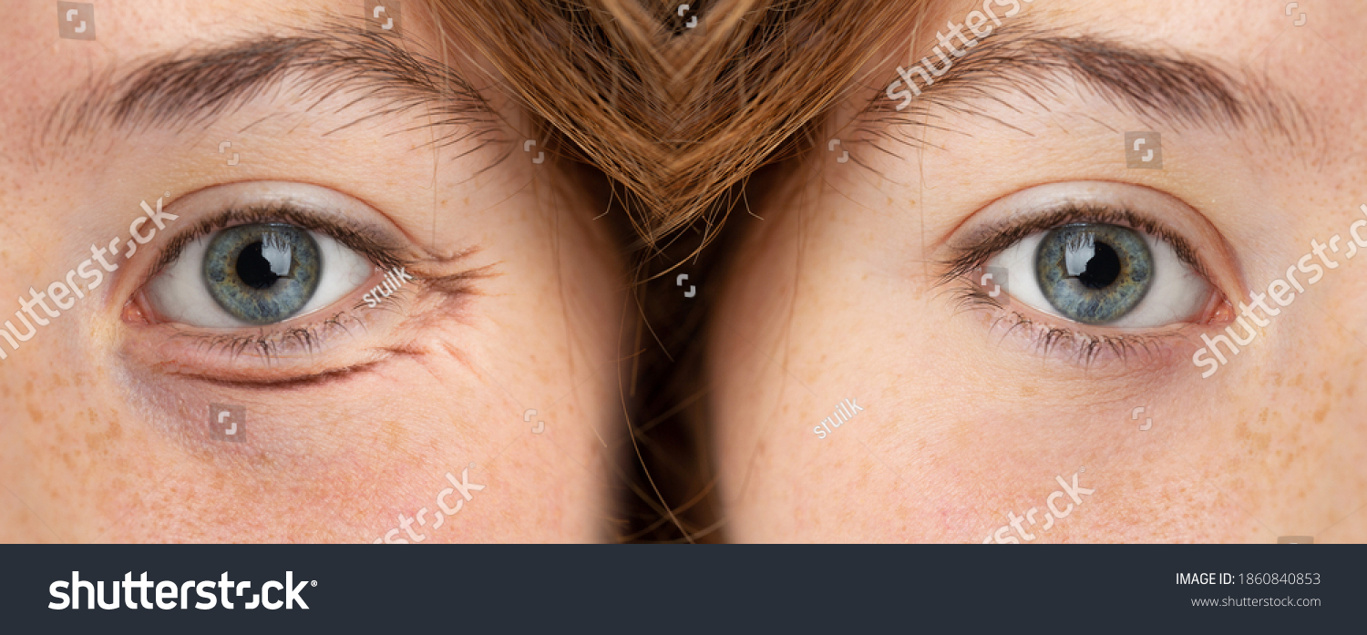Puffy Eye Woman Before After Removal Stock Fotografie 1860840853 puffy-eye-woman-before-after-removal-stock-fotografie-1860840853