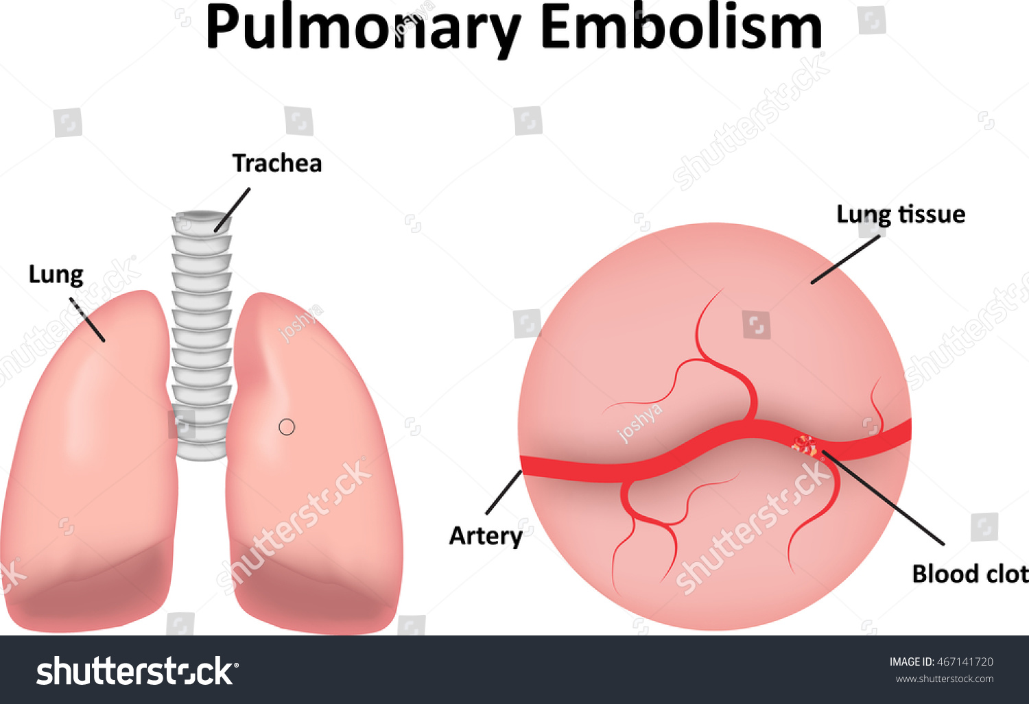 Pulmonary Embolism Diagram Stock Illustration 467141720