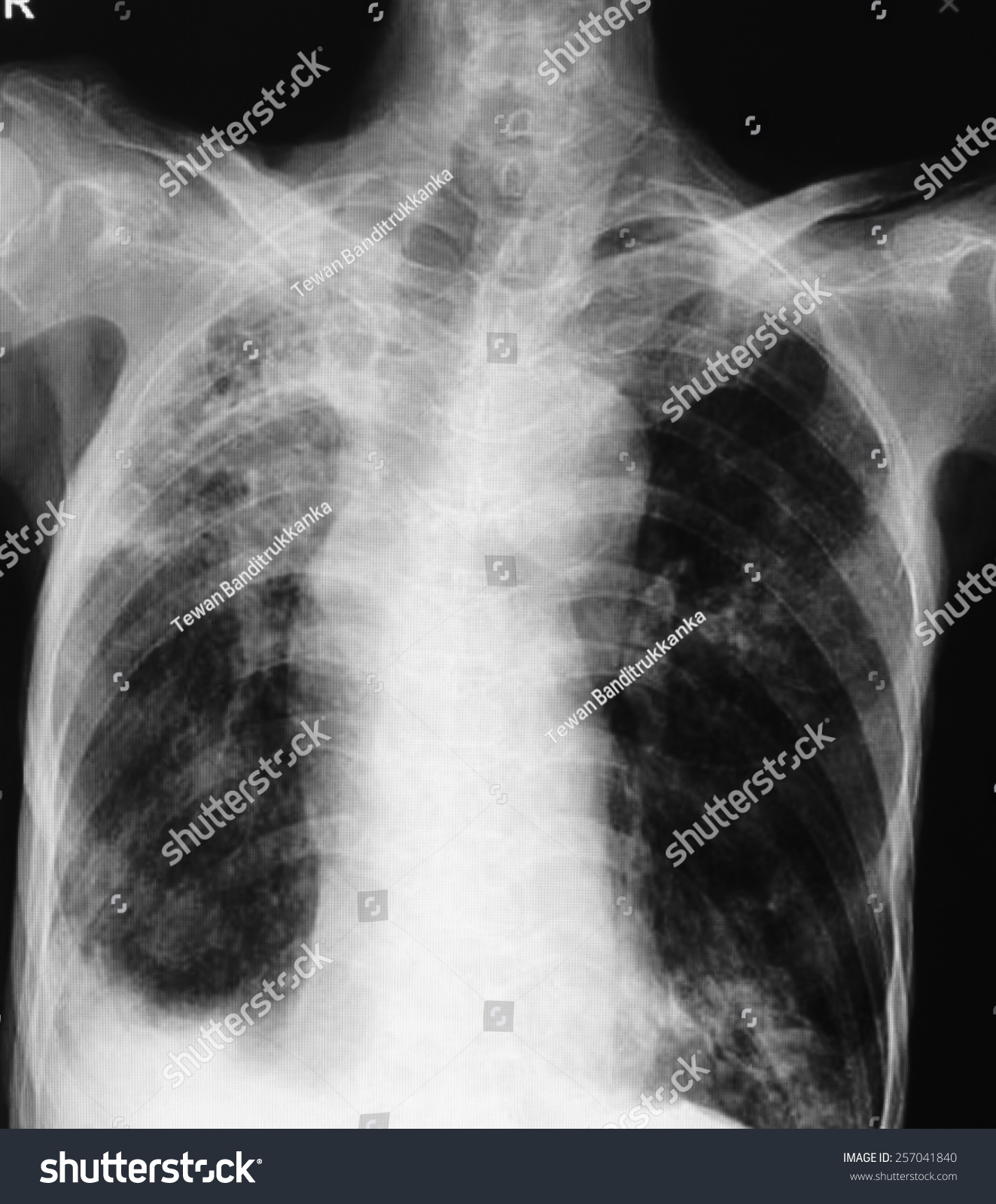 Pulmonary Tuberculosis Chest Xray Right Lung Stock Photo 257041840 ...