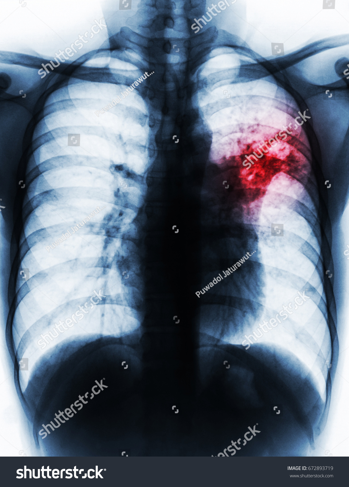 Pulmonary Tuberculosis Chest Xray Right Lung Atelecta - vrogue.co