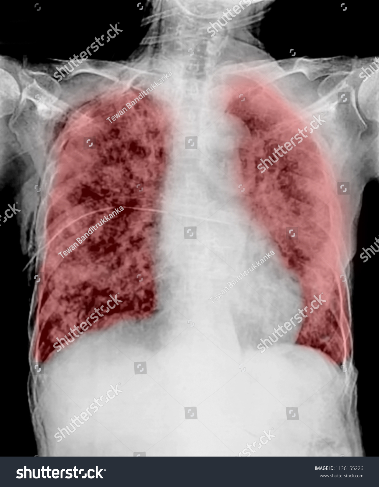 Pulmonary Tuberculosis Film Xray Chest Show Stock Photo 1136155226 ...